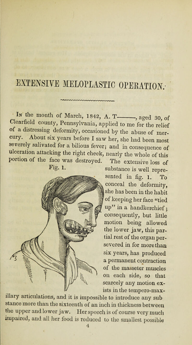 In the month of March, 1842, A. T-, aged 30, of Clearfield county, Pennsylvania, applied to me for the relief of a distressing deformity, occasioned by the abuse of mer¬ cury. About six years before I saw her, she had been most severely salivated for a bilious fever; and in consequence of ulceration attacking the right cheek, nearly the whole of this portion of the face was destroyed. The extensive loss of !• substance is well repre¬ sented in fig. 1. To conceal the deformity, I she has been in the habit of keeping her face “tied up” in a handkerchief; consequently, but little motion being allowed the lower jaw, this par¬ tial rest of the organ per¬ severed in for more than six years, has produced a permanent contraction of the masseter muscles on each side, so that scarcely any motion ex¬ ists in the tempero-max- illary articulations, and it is impossible to introduce any sub stance more than the sixteenth of an inch in thickness between the upper and lower jaw. Her speech is of course very much impaired, and all her food is reduced to the smallest possible 4