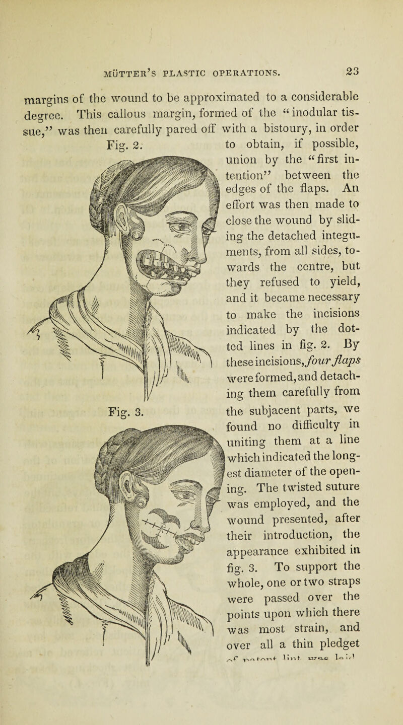 sue 5? Fig. 2. margins of the wound to be approximated to a considerable degree. This callous margin, formed of the “ modular tis- was then carefully pared off with a bistoury, in order to obtain, if possible, union by the “first in¬ tention” between the edges of the flaps. An effort was then made to close the wound by slid¬ ing the detached integu¬ ments, from all sides, to¬ wards the centre, but they refused to yield, and it became necessary to make the incisions indicated by the dot¬ ted lines in fig. 2. By these incisions, four flaps were formed, and detach¬ ing them carefully from the subjacent parts, we found no difficulty in uniting them at a line which indicated the long¬ est diameter of the open¬ ing. The twisted suture was employed, and the wound presented, after their introduction, the appearance exhibited in. fig. 3. To support the whole, one or two straps were passed over the points upon which there was most strain, and over all a thin pledget linf nr«ie *'-1 Fig. 3.