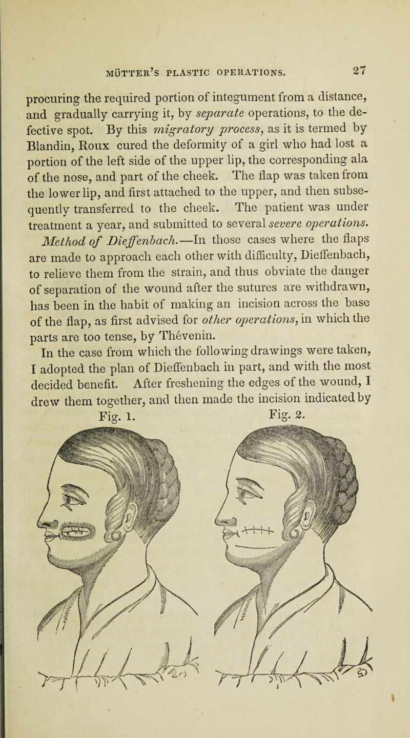 procuring the required portion of integument from a distance, and gradually carrying it, by separate operations, to the de¬ fective spot. By this migratory process, as it is termed by Blandin, Roux cured the deformity of a girl who had lost a portion of the left side of the upper lip, the corresponding ala of the nose, and part of the cheek. The flap was taken from the lower lip, and first attached to the upper, and then subse¬ quently transferred to the cheek. The patient was under treatment a year, and submitted to several severe operations. Method of Dieffenbach.—In those cases where the flaps are made to approach each other with difficulty, Dieffenbach, to relieve them from the strain, and thus obviate the danger of separation of the wound after the sutures are withdrawn, has been in the habit of making an incision across the base of the flap, as first advised for other operatio?is, in which the parts are too tense, by Thevenin. In the case from which the following drawings were taken, I adopted the plan of Dieffenbach in part, and with the most decided benefit. After freshening the edges of the wound, I drew them together, and then made the incision indicated by Fig. 1. Fig. 2.