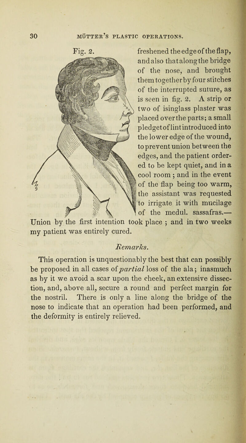 Fig. 2. freshened the edge of the flap, andalso thatalongthe bridge of the nose, and brought them together by four stitches of the interrupted suture, as is seen in fig. 2. A strip or two of isinglass plaster was placed over the parts; a small pledgetoflintintroduced into the lower edge of the wound, to prevent union between the edges, and the patient order¬ ed to be kept quiet, and in a cool room ; and in the event of the flap being too warm, the assistant was requested to irrigate it with mucilage of the medul. sassafras.— Union by the first intention took place ; and in two weeks my patient was entirely cured. it emarJcs. This operation is unquestionably the best that can possibly be proposed in all cases oi partial loss of the ala; inasmuch as by it we avoid a scar upon the cheek, an extensive dissec¬ tion, and, above all, secure a round and perfect margin for the nostril. There is only a line along the bridge of the nose to indicate that an operation had been performed, and the deformity is entirely relieved.
