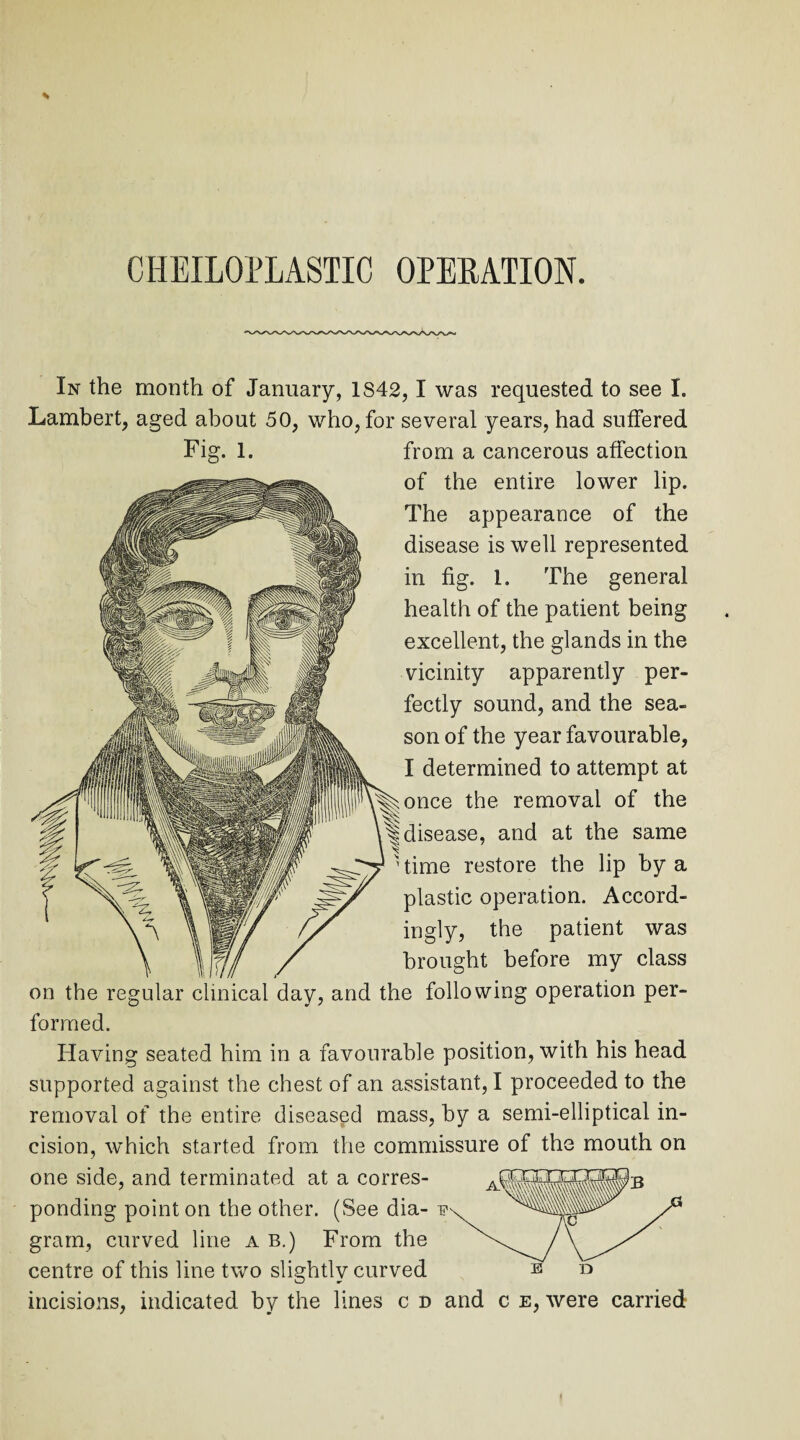 * In the month of January, 1S42,1 was requested to see I. Lambert, aged about 50, who, for several years, had suffered Fig. 1. from a cancerous affection of the entire lower lip. The appearance of the disease is well represented in fig. 1. The general health of the patient being excellent, the glands in the vicinity apparently per¬ fectly sound, and the sea¬ son of the year favourable, I determined to attempt at once the removal of the disease, and at the same time restore the lip by a plastic operation. Accord¬ ingly, the patient was brought before my class on the regular clinical day, and the following operation per¬ formed. Having seated him in a favourable position, with his head supported against the chest of an assistant, I proceeded to the removal of the entire diseased mass, by a semi-elliptical in¬ cision, which started from the commissure of the mouth on one side, and terminated at a corres- ponding point on the other. (See dia- i?\ Z3 gram, curved line a b.) From the \. /\ s' centre of this line two slightly curved B Q incisions, indicated by the lines c d and c e, were carried