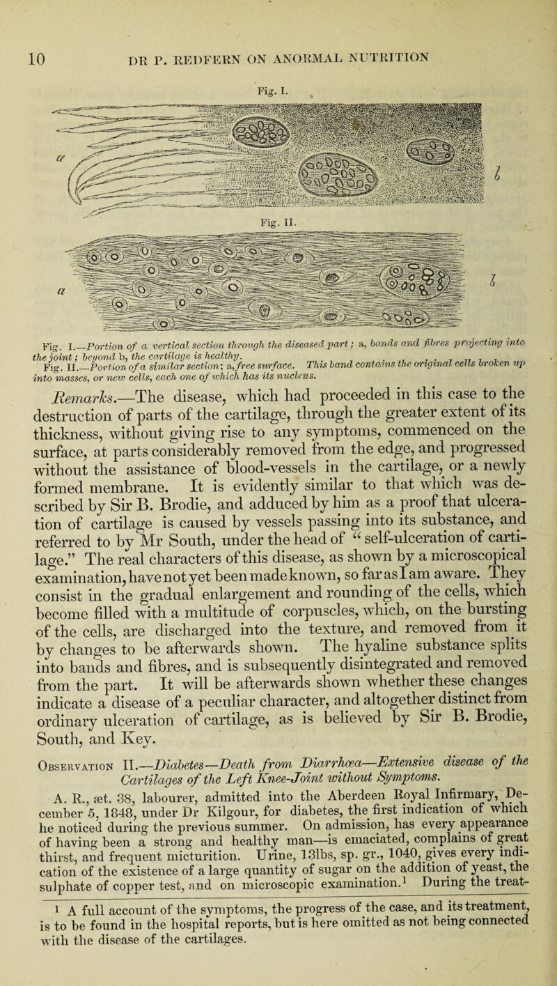 Fig. I. Fig. x._Portion of a vertical section through the diseased part; a, hands and fibres projecting into the joint; beyond b, the cartilage is healthy. . . . 7 , . Fig. II._Portion of a similar section; si, free surface. This band contains the original cells broken up into masses, or new cells, each one of ivhich has its nucleus. Remarks.—The disease, which had proceeded in this case to the destruction of parts of the cartilage, through the greater extent of its thickness, without giving rise to any symptoms, commenced on the surface, at parts considerably removed from the edge, and progressed without the assistance of blood-vessels in the cartilage, or a newly formed membrane. It is evidently similar to that which was de¬ scribed by Sir B. Brodie, and adduced by him as a proof that ulceia- tion of cartilage is caused by vessels passing into its substance, and referred to by Mr South, under the head of “ self-ulceration of carti¬ lage.” The real characters of this disease, as shown by a microscopical examination, havenotyet been made known, so faraslam aware. They consist in the gradual enlargement and rounding of the cells, which become filled with a multitude of corpuscles, which, on the bursting of the cells, are discharged into the texture, and removed from it by changes to be afterwards shown. The hyaline substance splits into bands and fibres, and is subsequently disintegrated and removed from the part. It will be afterwards shown whether these changes indicate a disease of a peculiar character, and altogether distinct from ordinary ulceration of cartilage, as is believed by Sir B. Brodie, South, and Ivey. Observation IIDiabetes —Death from Diarrhoea—Extensive disease of the Cartilages of the Left Knee-Joint without Symptoms. A. R., set. 38, labourer, admitted into the Aberdeen Royal Infirmary, De¬ cember 5, 1848, under Dr Kilgour, for diabetes, the first indication of which he noticed during the previous summer. On admission, has every appearance of having been a strong and healthy man—is emaciated, complains of gieat thirst, and frequent micturition. Urine, 13lbs, sp. gr., 1040, gives every indi¬ cation of the existence of a large quantity of sugar on the addition of yeast, the sulphate of copper test, and on microscopic examination.1 During the treat- i A full account of the symptoms, the progress of the case, and its treatment, is to be found in the hospital reports, but is here omitted as not being connected with the disease of the cartilages.