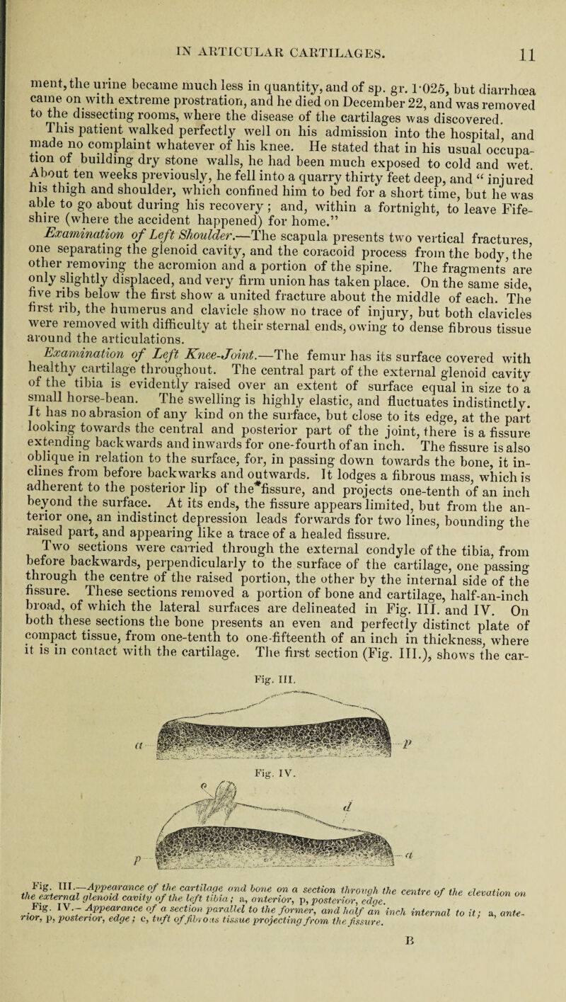 ment,the urine became much less in quantity, and of sp. gr. 1*025, but diarrhoea came on with extreme prostration, and he died on December 22, and was removed to the dissecting-rooms, where the disease of the cartilages was discovered. This patient walked perfectly well on his admission into the hospital and made no complaint whatever of his knee. He stated that in his usual occupa¬ tion of building dry stone walls, he had been much exposed to cold and wet. About ten weeks previously, he fell into a quarry thirty feet deep, and “ injured his thigh and shoulder, which confined him to bed for* a short time, but he was able to go about during his recovery; and, within a fortnight, to leave Fife- shire (where the accident happened) for home.” Examination of Left Shoulder.—The scapula presents two vertical fractures one separating the glenoid cavity, and the coracoid process from the body the other removing the acromion and a portion of the spine. The fragments’ are only slightly displaced, and very firm union has taken place. On the same side five ribs below the first show a united fracture about the middle of each. The’ first rib, the humerus and clavicle show no trace of injury, but both clavicles wei e lemoved with difficulty at their sternal ends, owing to dense fibrous tissue around the articulations. Examination of Left Knee-Joint.—The femur has its surface covered with healthy cartilage throughout. The central part of the external glenoid cavity of the tibia is evidently raised over an extent of surface equal in size to a small horse-bean. The swelling is highly elastic, and fluctuates indistinctly. It has no abrasion of any kind on the surface, but close to its edge, at the part looking towards the central and posterior part of the joint, there is a fissure extending backwards and inwards for one-fourth of an inch. The fissure is also oblique in relation to the surface, for, in passing down towards the bone, it in¬ clines from before backwayks and outwards. It lodges a fibrous mass, which is adherent to the posterior lip of the*fissure, and projects one-tenth of an inch beyond the surface.. At its ends, the fissure appears limited, but from the an¬ terior one, an indistinct depression leads forwards for two lines, bounding the raised part, and appearing like a trace of a healed fissure. Two sections were carried through the external condyle of the tibia, from before backwards, perpendicularly to the surface of the cartilage, one passing- through the centre of the raised portion, the other by the internal side of the fissure. These sections removed a portion of bone and cartilage, half-an-inch broad, of which the lateral surfaces are delineated in Fig. III. and IV. On both these sections the bone presents an even and perfectly distinct plate of compact tissue, from one-tenth to one-fifteenth of an inch in thickness where it is in contact with the cartilage. The first section (Fig. III.), shows the car- Fig. III. a P Fig. IV. P a -t v, cujt, uj jwi tmb tissue projecting jrom the fissure. B