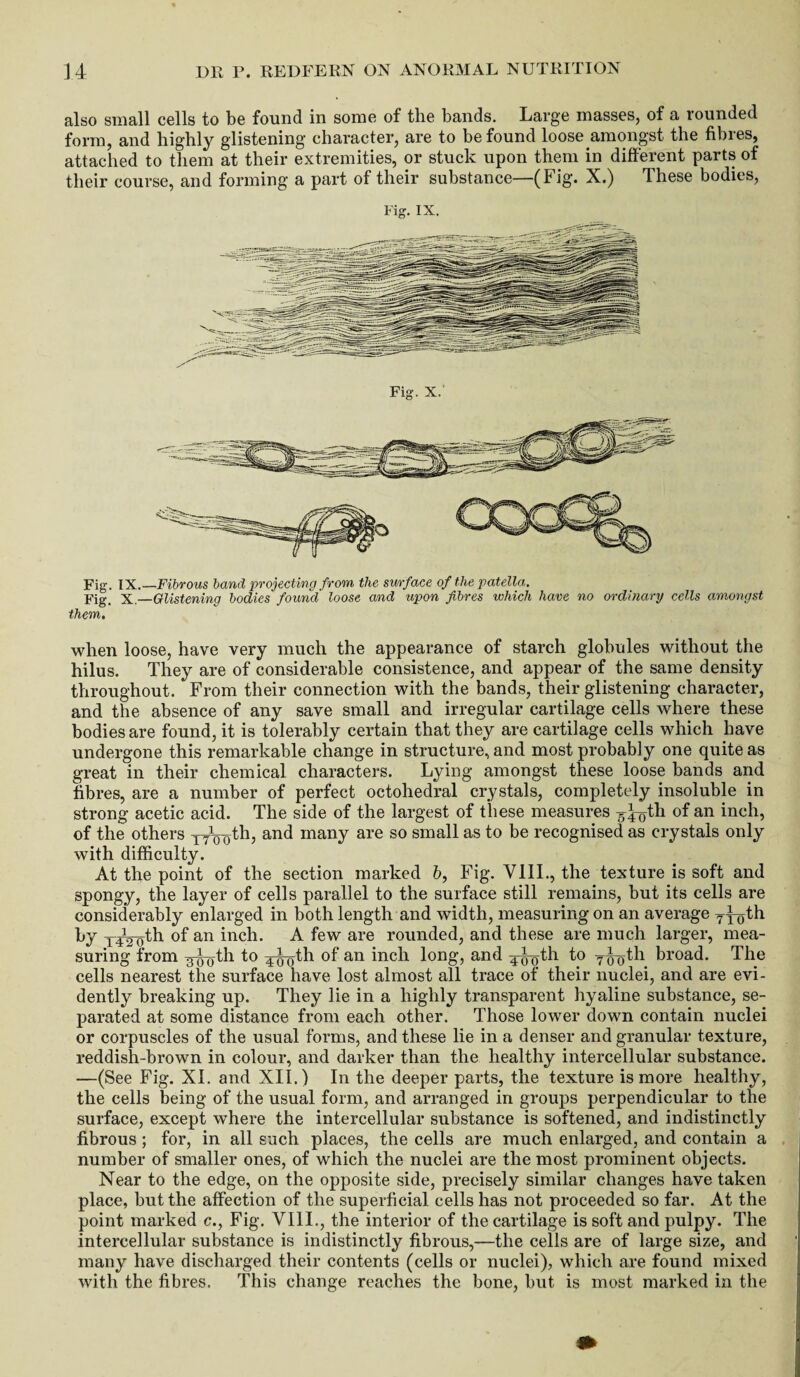 also small cells to be found in some of the bands. Large masses, of a rounded form, and highly glistening character, are to be found loose amongst the fibres, attached to them at their extremities, or stuck upon them in different parts of their course, and forming a part of their substance—(Fig. X.) These bodies, Fig. X. Fig. IX.—Fibrous band projecting from the surface of the patella. Fig. X—Glistening bodies found loose and upon fibres which have no ordinary cells amongst them. when loose, have very much the appearance of starch globules without the hilus. They are of considerable consistence, and appear of the same density throughout. From their connection with the bands, their glistening character, and the absence of any save small and irregular cartilage cells where these bodies are found, it is tolerably certain that they are cartilage cells which have undergone this remarkable change in structure, and most probably one quite as great in their chemical characters. Lying amongst these loose bands and fibres, are a number of perfect octohedral crystals, completely insoluble in strong acetic acid. The side of the largest of these measures 540th of an inch, of the others p^th, and many are so small as to be recognised as crystals only with difficulty. At the point of the section marked 6, Fig. VIII., the texture is soft and spongy, the layer of cells parallel to the surface still remains, but its cells are considerably enlarged in both length and width, measuring on an average T4oth by x^iyth of an inch. A few are rounded, and these are much larger, mea¬ suring from 450^ °f an inch long, and broad. The cells nearest the surface have lost almost all trace of their nuclei, and are evi¬ dently breaking up. They lie in a highly transparent hyaline substance, se¬ parated at some distance from each other. Those lower down contain nuclei or corpuscles of the usual forms, and these lie in a denser and granular texture, reddish-brown in colour, and darker than the healthy intercellular substance. —(See Fig. XI. and XII.) In the deeper parts, the texture is more healthy, the cells being of the usual form, and arranged in groups perpendicular to the surface, except where the intercellular substance is softened, and indistinctly fibrous ; for, in all such places, the cells are much enlarged, and contain a number of smaller ones, of which the nuclei are the most prominent objects. Near to the edge, on the opposite side, precisely similar changes have taken place, but the affection of the superficial cells has not proceeded so far. At the point marked c., Fig. VIII., the interior of the cartilage is soft and pulpy. The intercellular substance is indistinctly fibrous,—the cells are of large size, and many have discharged their contents (cells or nuclei), which are found mixed with the fibres. This change reaches the bone, but is most marked in the