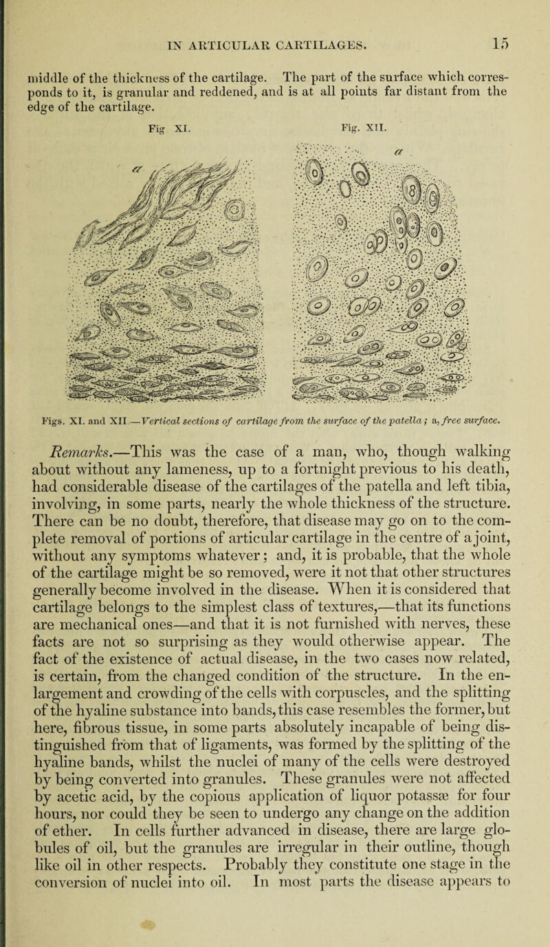 middle of the thickness of the cartilage. The part of the surface which corres¬ ponds to it, is granular and reddened, and is at all points far distant from the edge of the cartilage. Fig XI. Fig. XII. Figs. XI. and XII.—Vertical sections of cartilage from the surface of the patella; a; free surface. Remarks.—This was the case of a man, who, though walking about without any lameness, up to a fortnight previous to his death, had considerable disease of the cartilages of the patella and left tibia, involving, in some parts, nearly the whole thickness of the structure. There can be no doubt, therefore, that disease may go on to the com¬ plete removal of portions of articular cartilage in the centre of a joint, without any symptoms whatever; and, it is probable, that the whole of the cartilage might be so removed, were it not that other structures generally become involved in the disease. When it is considered that cartilage belongs to the simplest class of textures,—that its functions are mechanical ones—and that it is not furnished with nerves, these facts are not so surprising as they would otherwise appear. The fact of the existence of actual disease, in the two cases now related, is certain, from the changed condition of the structure. In the en¬ largement and crowding of the cells with corpuscles, and the splitting of the hyaline substance into bands, this case resembles the former, hut here, fibrous tissue, in some parts absolutely incapable of being dis¬ tinguished from that of ligaments, was formed by the splitting of the hyaline bands, whilst the nuclei of many of the cells were destroyed by being converted into granules. These granules were not affected by acetic acid, by the copious application of liquor potassae for four hours, nor could they be seen to undergo any change on the addition of ether. In cells further advanced in disease, there are large glo¬ bules of oil, but the granules are irregular in their outline, though like oil in other respects. Probably they constitute one stage in the conversion of nuclei into oil. In most parts the disease appears to