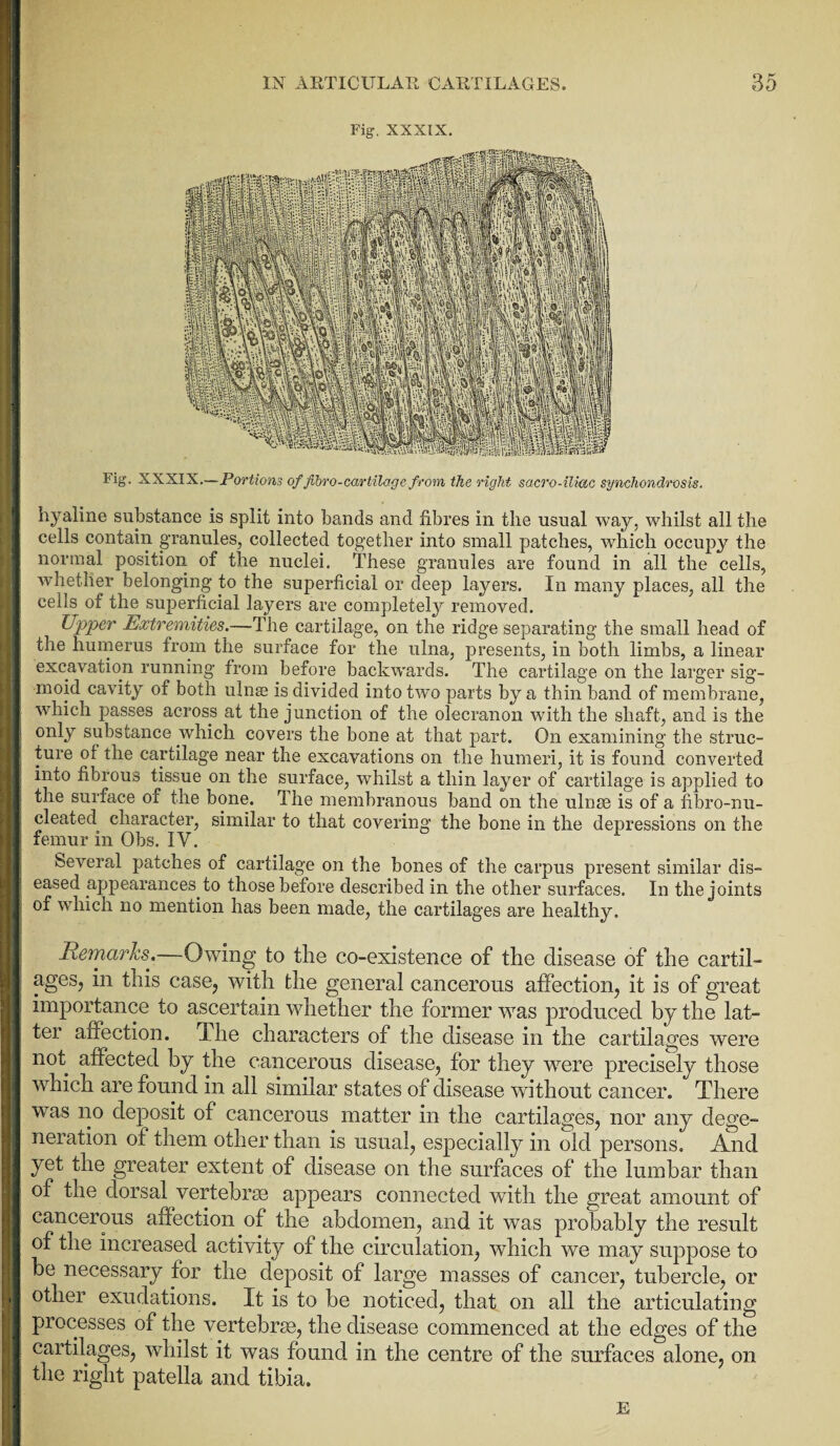 Fig. XXXIX. Fig. XXXIX.—Portions of fibro-cartilage from the right sacro-ilmc synchondrosis. hyaline substance is split into bands and fibres in the usual way, whilst all the cells contain granules, collected together into small patches, which occupy the normal position of the nuclei. These granules are found in all the cells, whether belonging to the superficial or deep layers. In many places, all the cells of the superficial layers are completely removed. tipper Extremities.—The cartilage, on the ridge separating the small head of the humerus from the surface for the ulna, presents, in both limbs, a linear excavation running from before backwards. The cartilage on the larger sig¬ moid cavity of both ulnae is divided into two parts by a thin band of membrane, which passes across at the junction of the olecranon with the shaft, and is the only substance which covers the bone at that part. On examining the struc¬ ture of the cartilage near the excavations on the humeri, it is found converted into fibrous tissue on the surface, whilst a thin la}mr of cartilage is applied to the surface or the bone. The membranous band on the ulnae is of a fibro-nu- cleated character, similar to that covering the bone in the depressions on the femur in Ohs. IV. 1 beveral patches of cartilage on the bones of the carpus present similar dis¬ eased appearances to those before described in the other surfaces. In the joints of which no mention has been made, the cartilages are healthy. Remarks.—Owing to the co-existence of the disease of the cartil¬ ages, in this case, with the general cancerous affection, it is of great importance to ascertain whether the former was produced by the lat¬ ter affection. The characters of the disease in the cartilages were not affected by the cancerous disease, for they were precisely those which are found in all similar states of disease without cancer. There was no deposit of cancerous matter in the cartilages, nor any dege¬ neration of them other than is usual, especially in old persons. And yet the greater extent of disease on the surfaces of the lumbar than of the dorsal vertebrae appears connected with the great amount of cancerous affection of the abdomen, and it was probably the result of the increased activity of the circulation, which we may suppose to be necessary tor the deposit of large masses of cancer, tubercle, or other exudations. It is to be noticed, that on all the articulating processes of the vertebrae, the disease commenced at the edges of the cartilages, whilst it was found in the centre of the surfaces alone, on the right patella and tibia. E