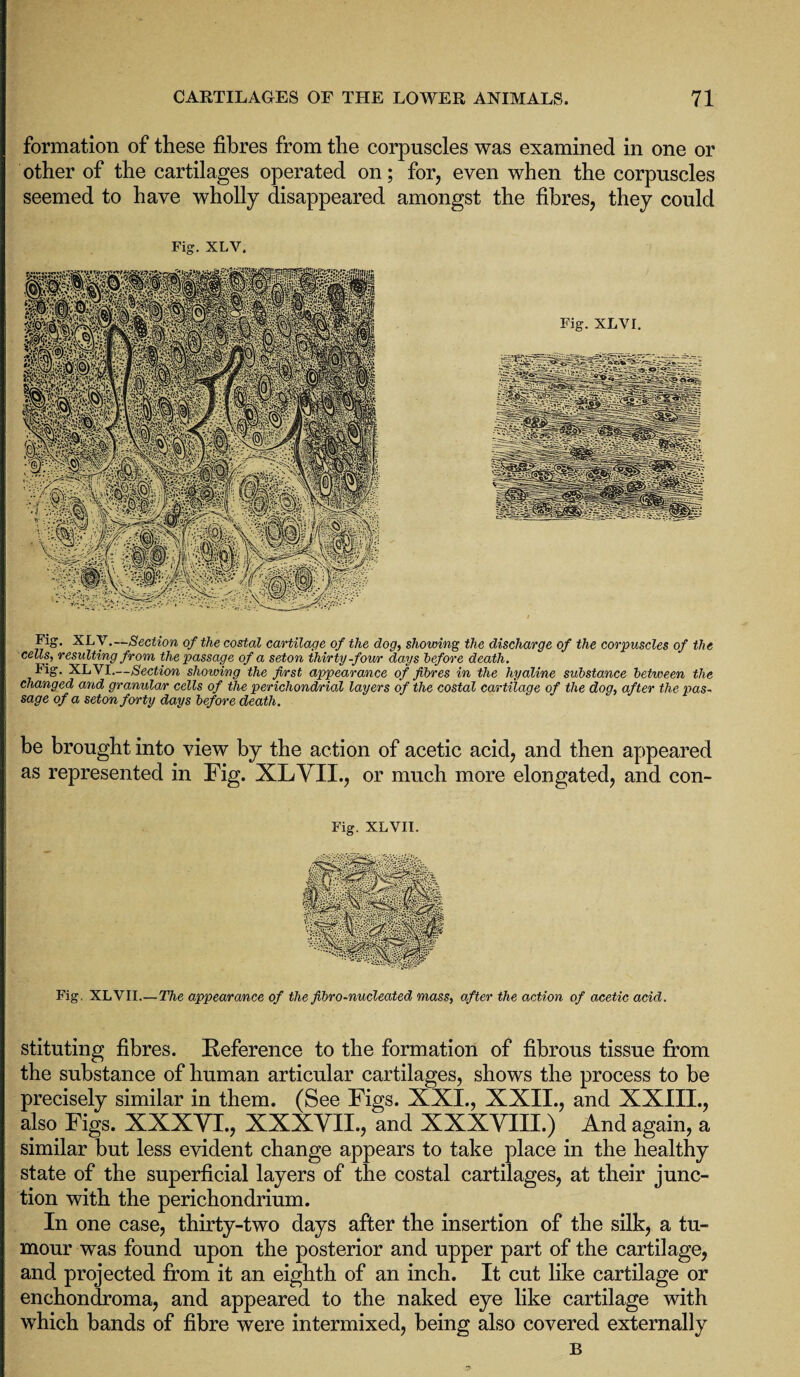 formation of these fibres from the corpuscles was examined in one or other of the cartilages operated on; for, even when the corpuscles seemed to have wholly disappeared amongst the fibres, they could Fig. XLV. Fig. XLVI. Fig. XLV.—Section of the costal cartilage of the dog, showing the discharge of the corpuscles of the cells, resulting from the passage of a seton thirty -four days before death. Fig. XLVI.—Section showing the first appearance of fibres in the hyaline substance between the changed and granular cells of the perichondrial layers of the costal cartilage of the dog, after the pas¬ sage of a seton forty days before death. be brought into view by the action of acetic acid, and then appeared as represented in Fig. XLVII., or much more elongated, and con- Fig. XLVII. %§lfpifik stpilt ' ll yf ■ VS X. W Fig. XLVII_The appearance of the fibro-nucleated mass, after the action of acetic acid. stituting fibres. Reference to the formation of fibrous tissue from the substance of human articular cartilages, shows the process to be precisely similar in them. (See Figs. XXI., XXII., and XXIII., also Figs. XXXVI., XXXVII., and XXXVIII.) And again, a similar but less evident change appears to take place in the healthy state of the superficial layers of the costal cartilages, at their junc¬ tion with the perichondrium. In one case, thirty-two days after the insertion of the silk, a tu¬ mour was found upon the posterior and upper part of the cartilage, and projected from it an eighth of an inch. It cut like cartilage or enchondroma, and appeared to the naked eye like cartilage with which bands of fibre were intermixed, being also covered externally B