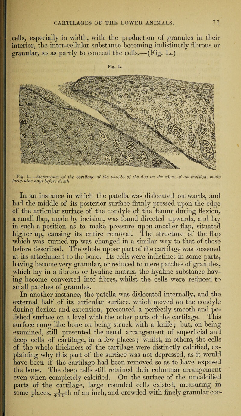 cells, especially in width, with the production of granules in their interior, the inter-cellular substance becoming indistinctly fibrous or granular, so as partly to conceal the cells.—(Fig. L.) Fig. L. Fig. L. -Appearance of the cartilage of the patella of the dog on the edges of an incision, made forty-nine days before death In an instance in which the patella was dislocated outwards, and had the middle of its posterior surface firmly pressed upon the edge of the articular surface of the condyle of the femur during flexion, a small flap, made by incision, was found directed upwards, and lay in such a position as to make pressure upon another flap, situated higher up, causing its entire removal. The structure of the flap which was turned up was changed in a similar way to that of those before described. The whole upper part of the cartilage was loosened at its attachment to the bone. Its cells were indistinct in some parts, haying become very granular, or reduced to mere patches of granules, which lay in a fibrous or hyaline matrix, the hyaline substance hav¬ ing become converted into fibres, wdiilst the cells were reduced to small patches of granules. In another instance, the patella was dislocated internally, and the external half of its articular surface, which moved on the condyle during flexion and extension, presented a perfectly smooth and po¬ lished surface on a level with the other parts of the cartilage. This surface rung like bone on being struck with a knife; but, on being examined, still presented the usual arrangement of superficial and deep cells of cartilage, in a few places; whilst, in others, the cells of the whole thickness of the cartilage were distinctly calcified, ex¬ plaining why this part of the surface was not depressed, as it would have been if the cartilage had been removed so as to have exposed the bone. The deep cells still retained their columnar arrangement even when completely calcified. On the surface of the uncalcified parts of the cartilage, large rounded cells existed, measuring in some places, ^^th of an inch, and crowded with finely granular cor-