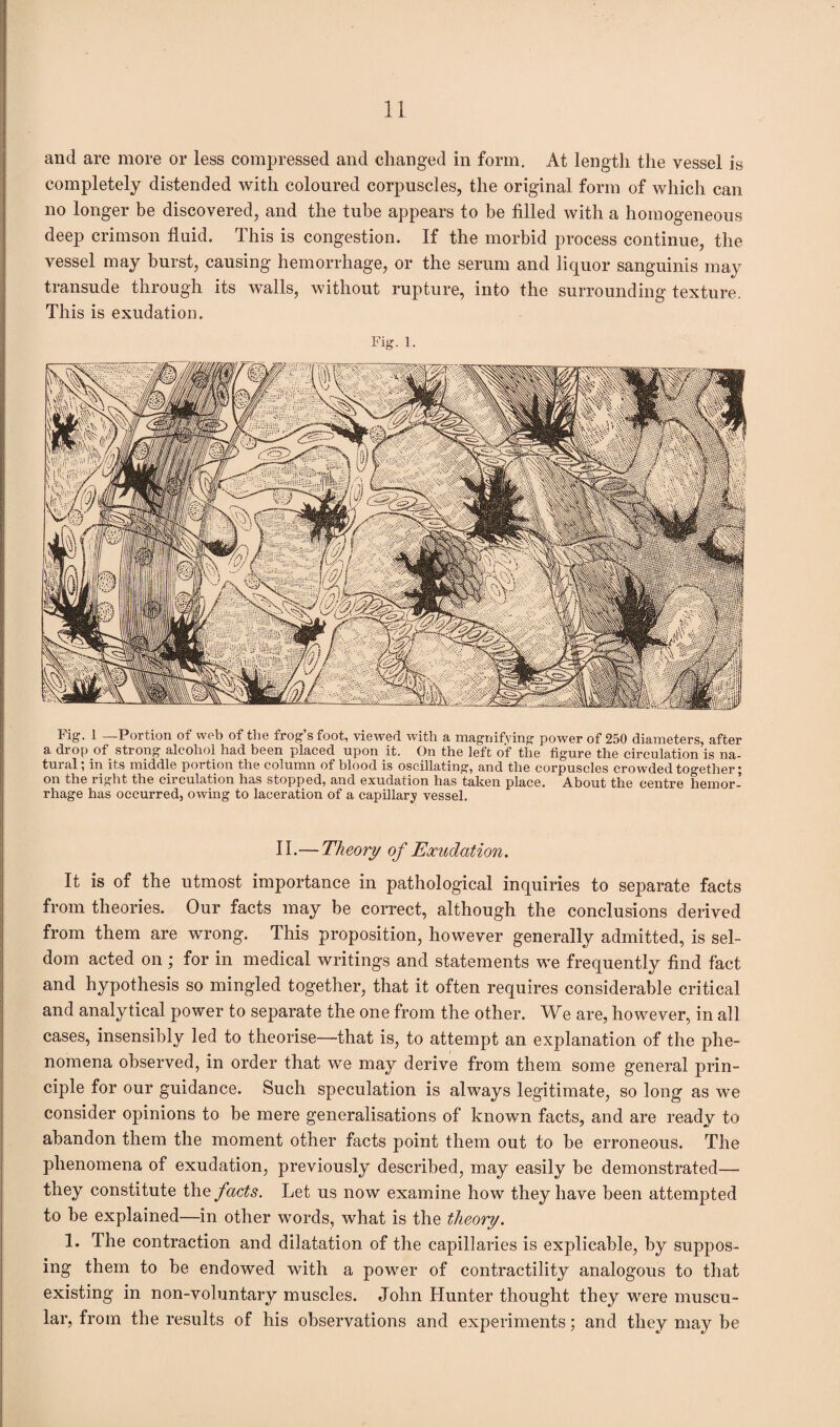 and are more or less compressed and changed in form. At length the vessel is completely distended with coloured corpuscles, the original form of which can no longer be discovered, and the tube appears to be filled with a homogeneous deep crimson fluid. This is congestion. If the morbid process continue, the vessel may burst, causing hemorrhage, or the serum and liquor sanguinis may transude through its walls, without rupture, into the surrounding texture. This is exudation. Fig. 1. Fig. 1 —Portion of web of the frog’s foot, viewed with a magnifying power of 250 diameters, after a drop of strong alcohol had been placed upon it. On the left of the figure the circulation is na¬ tural ; in its middle portion the column of blood is oscillating, and the corpuscles crowded together; on the right the circulation has stopped, and exudation has taken place. About the centre hemor¬ rhage has occurred, owing to laceration of a capillary vessel. II.— Theory of Exudation. It is of the utmost importance in pathological inquiries to sejjarate facts from theories. Our facts may be correct, although the conclusions derived from them are wrong. This proposition, however generally admitted, is sel¬ dom acted on; for in medical writings and statements we frequently find fact and hypothesis so mingled together, that it often requires considerable critical and analytical power to separate the one from the other. We are, however, in all cases, insensibly led to theorise—that is, to attempt an explanation of the phe¬ nomena observed, in order that we may derive from them some general prin¬ ciple for our guidance. Such speculation is always legitimate, so long as we consider opinions to be mere generalisations of known facts, and are ready to abandon them the moment other facts point them out to be erroneous. The phenomena of exudation, previously described, may easily be demonstrated—- they constitute the facts. Let us now examine how they have been attempted to be explained—in other words, what is the theory. 1. The contraction and dilatation of the capillaries is explicable, by suppos¬ ing them to be endowed with a power of contractility analogous to that existing in non-voluntary muscles. John Hunter thought they were muscu¬ lar, from the results of his observations and experiments; and they may be