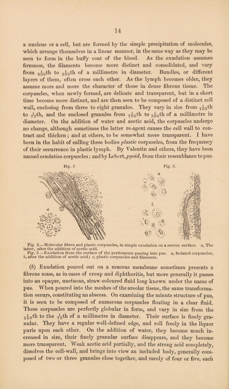 a nucleus or a cell, but are formed by the simple precipitation of molecules, which arrange themselves in a linear manner, in the same way as they may be seen to form in the buffy coat of the blood. As the exudation assumes firmness, the filaments become more distinct and consolidated, and vary from g-jj-oth to 5-jjoth of a millimetre in diameter. Bundles, or different layers of them, often cross each other. As the lymph becomes older, they assume more and more the character of those in dense fibrous tissue. The corpuscles, when newly formed, are delicate and transparent, but in a short time become more distinct, and are then seen to be composed of a distinct cell wall, enclosing from three to eight granules. They vary in size from y^th to y^th, and the enclosed granules from y^th to yyoth of a millimetre in diameter. On the addition of water and acetic acid, the corpuscles undergo no change, although sometimes the latter re-agent causes the cell wall to con¬ tract and thicken; and at others, to be somewhat more transparent. I have been in the habit of calling these bodies plastic corpuscles, from the frequency of their occurrence in plastic lymph. By Valentin and others, they have been named exudation corpuscles; and by Lebert, pyoid, from their resemblance to pus. Fig. 2 Fig. 3. Fig. 2.—Molecular fibres and plastic corpuscles, in simple exudation on a serous surface, a, The latter, after the addition of acetic acid. Fig. 3 —Exudation from the surface of the peritoneum passing into pus. a, Isolated corpuscles; h, after the addition of acetic acid; c, plastic corpuscles and filaments. (b) Exudation poured out on a mucous membrane sometimes presents a fibrous mass, as in cases of croup and diphtheritis, but more generally it passes into an opaque, unctuous, straw-coloured fluid long known under the name of pus. When poured into the meshes of the areolar tissue, the same transforma¬ tion occurs, constituting an abscess. On examining the minute structure of pus, it is seen to be composed of numerous corpuscles floating in a clear fluid. These corpuscles are perfectly globular in form, and vary in size from the Ti^th to the yg'th of a millimetre in diameter. Their surface is finely gra¬ nular. They have a regular well-defined edge, and roll freely in the liquor puris upon each other. On the addition of water, they become much in¬ creased in size, their finely granular surface disappears, and they become more transparent. Weak acetic acid partially, and the strong acid completely, dissolves the cell-wall, and brings into view an included body, generally com¬ posed of two or three granules close together, and rarely of four or five, each