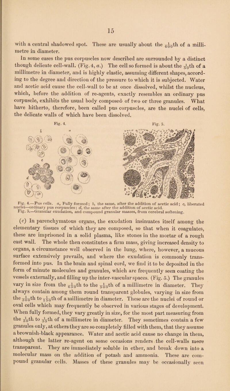 with a central shadowed spot. These are usually about the ^^th of a milli¬ metre in diameter. In some cases the pus corpuscles now described are surrounded by a distinct though delicate cell-wall. (Fig. 4, a.) The cell so formed is about the ^th °f a millimetre in diameter, and is highly elastic, assuming different shapes, accord¬ ing to the degree and direction of the pressure to which it is subjected. Water and acetic acid cause the cell-wall to be at once dissolved, whilst the nucleus, which, before the addition of re-agents, exactly resembles an ordinary pus corpuscle, exhibits the usual body composed/ of two or three granules. What have hitherto, therefore, been called pus corpuscles, are the nuclei of cells, the delicate walls of which have been dissolved. Fig. 4. Fig. 5. Fig. 4.—Pus cells, a, Fully formed; b, the same, after the addition of aeetio acid; c, liberated nuclei—ordinary pus corpuscles; d, the same after the addition of acetic acid. Fig. 5.—Granular exudation, and compound granular masses, from cerebral softening. (c) In parenchymatous organs, the exudation insinuates itself among the elementary tissues of which they are composed, so that when it coagulates, these are imprisoned in a solid plasma, like stones in the mortar of a rough cast wall. The whole then constitutes a firm mass, giving increased density to organs, a circumstance well observed in the lung, where, however, a mucous surface extensively prevails, and where the exudation is commonly trans¬ formed into pus. In the brain and spinal cord, we find it to be deposited in the form of minute molecules and granules, which are frequently seen coating the vessels externally, and filling up the inter-vascular spaces. (Fig. 5.) The granules vary in size from the gd^th to the g^th of a millimetre in diameter. They always contain among them round transparent globules, varying in size from the Mo^h to x^oth of a millimetre in diameter. These are the nuclei of round or oval cells which may frequently be observed in various stages of development. When fully formed, they vary greatly in size, for the most part measuring from the F&th 1° Fgdh of a millimetre in diameter. They sometimes contain a few granules only, at others they are so completely filled with them, that they assume a brownish-black appearance. Water and acetic acid cause no change in them, although the latter re-agent on some occasions renders the cell-walls more transparent. They are immediately soluble in ether, and break down into a molecular mass on the addition of potash and ammonia. These are com¬ pound granular cells. Masses of these granules may be occasionally seen