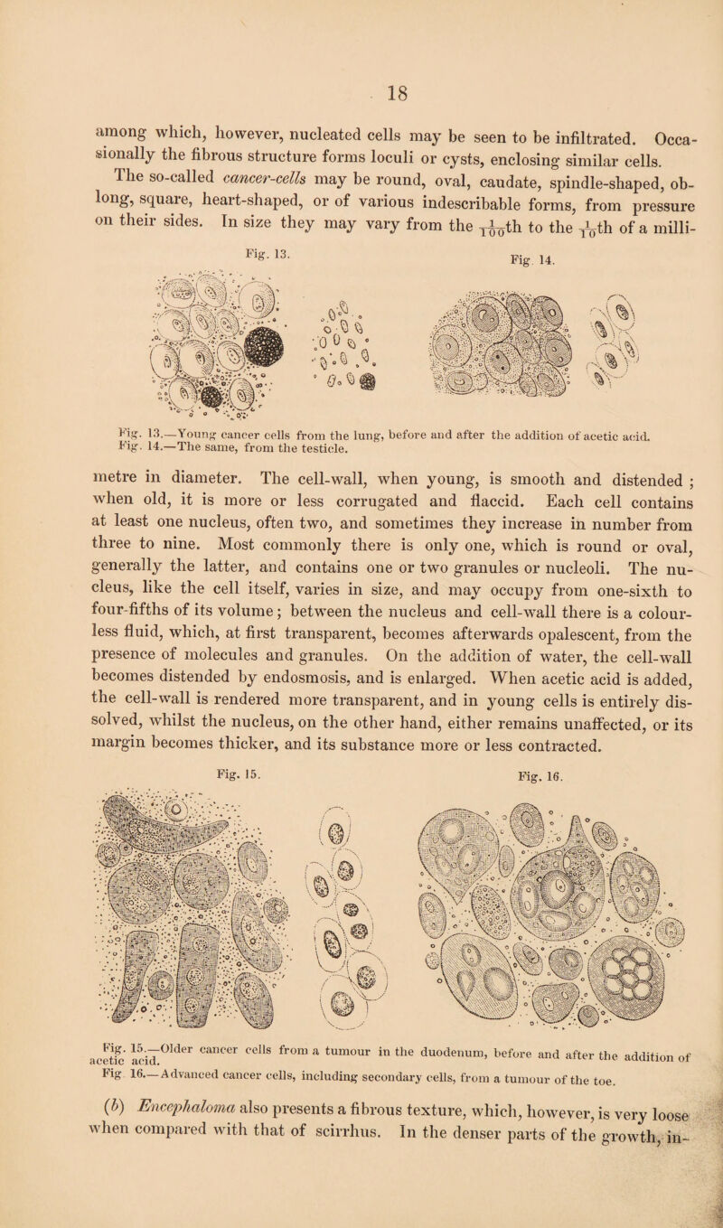 among which, however, nucleated cells may be seen to be infiltrated. Occa¬ sionally the fibrous structure forms loculi or cysts, enclosing similar cells. The so-called cancer-cells may be round, oval, caudate, spindle-shaped, ob- long, squai e, heai t-shaped, or of various indescribable forms, from pressure on their sides. In size they may vary from the ^th to the ^th of a milli- Fig. 13. Fig 14. Fig. 13.—Young cancer cells from the lung, before and after the addition of acetic acid. Fig. 14.—The same, from the testicle. metre in diameter. The cell-wall, when young, is smooth and distended ; when old, it is more or less corrugated and flaccid. Each cell contains at least one nucleus, often two, and sometimes they increase in number from three to nine. Most commonly there is only one, which is round or oval, generally the latter, and contains one or two granules or nucleoli. The nu¬ cleus, like the cell itself, varies in size, and may occupy from one-sixth to four-fifths of its volume; between the nucleus and cell-wall there is a colour¬ less fluid, which, at first transparent, becomes afterwards opalescent, from the presence of molecules and granules. On the addition of water, the cell-wall becomes distended by endosmosis, and is enlarged. When acetic acid is added, the cell-wall is rendered more transparent, and in young cells is entirely dis¬ solved, whilst the nucleus, on the other hand, either remains unaffected, or its margin becomes thicker, and its substance more or less contracted. Fig. 15. Fig. 16. acetfc ieicL°lder CanCer °ellS fr°m a tUmOUr in the duodenum- before and after the addition of Fig 16—Advanced cancer cells, including secondary cells, from a tumour of the toe. (b) Encephaloma also presents a fibrous texture, which, however, is very loose when compared with that of scirrhus. In the denser parts of the growth, in-