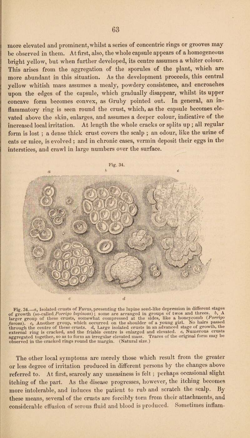 more elevated and prominent, whilst a series of concentric rings or grooves may¬ be observed in them. At first, also, the whole capsule appears of a homogeneous bright yellow, but when further developed, its centre assumes a whiter colour. This arises from the aggregation of the sporules of the plant, which are more abundant in this situation. As the development proceeds, this central yellow whitish mass assumes a mealy, powdery consistence, and encroaches upon the edges of the capsule, which gradually disappear, whilst its upper concave form becomes convex, as Gruby pointed out. In general, an in¬ flammatory ring is seen round the crust, which, as the capsule becomes ele¬ vated above the skin, enlarges, and assumes a deeper colour, indicative of the increased local irritation. At length the whole cracks or splits up; all regular form is lost ; a dense thick crust covers the scalp ; an odour, like the urine of cats or mice, is evolved ; and in chronic cases, vermin deposit their eggs in the interstices, and crawl in large numbers over the surface. Fig. 34. G d Fig. 34._a, Isolated crusts of Favus, presenting the lupine seed-like depression in different stages of growth (so-called Porrigo lupinosa); some are arranged in groups of twos and threes, b, A larger group of these crusts, somewhat compressed at the sides, like a honeycomb (Forrigo favosa), c, Another group, which occurred on the shoulder of a young girl. No hairs passed through the centre of these crusts, d, Large isolated crusts in an advanced stage of growth, the external ring is cracked, and the friable centre is enlarged and elevated, e, Numerous crusts aggregated together, so as to form an irregular elevated mass. Traces of the original form may be observed in the cracked rings round the margin. (Natural size.) The other local symptoms are merely those which result from the greater or less degree of irritation produced in different persons by the changes above referred to. At first, scarcely any uneasiness is felt; perhaps occasional slight itching of the part. As the disease progresses, however, the itching becomes more intolerable, and induces the patient to rub and scratch the scalp. By these means, several of the crusts are forcibly torn from their attachments, and considerable effusion of serous fluid and blood is produced. Sometimes inflam-