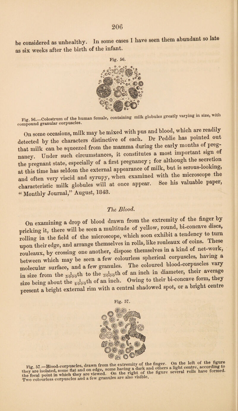 be considered as unhealthy. In some cases I have seen them abundant so late as six weeks after the birth of the infant. Fig. 56. Fig. 56._Colostrum of the human female, containing milk globules greatly varying in size, with compound granular corpuscles. On some occasions, milk may be mixed with pus and blood, which are readily detected by the characters distinctive of each. Dr Peddle has pointed out that milk can be squeezed from the mamma during the early months of pieg- nanev. Under such circumstances, it constitutes a most important sign of the pregnant state, especially of a first pregnancy ; for although the secretion at this time has seldom the external appearance of milk, but is serous-looking, and often very viscid and syrupy, when examined with the microscope the characteristic milk globules will at once appear. See Ins valuable papei, “ Monthly Journal,” August, 1848. The Blood. On examining a drop of blood drawn from the extremity of the finger by pricking it, there will be seen a multitude of yellow, round, bi-concave discs, rolling in the field of the microscope, which soon exhibit a tendency to turn upon their edge, and arrange themselves in rolls, like rouleaux of coins. ese rouleaux, by crossing one another, dispose themselves in a kind of net-woi , between which may be seen a few colourless spherical corpuscles, having a molecular surface, and a few granules. The coloured blood-corpuscles vary in size from the ^th to the ^th of an inch in diameter, then aveiage size being about the ^th of an inch. Owing to their bi-concave form, they present a bright external rim with a central shadowed spot, or a bright centie Fig. 57. Fig. 57.-Blood-corpuscles, drawn from a°lfght centre^accordhfg^o on the right of the figure several rolls have formed. Two colourless corpuscles and a lew granules are also visible.