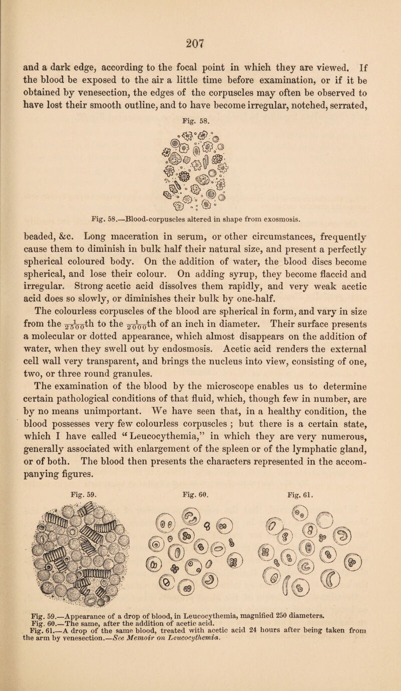 and a dark edge, according to the focal point in which they are viewed. If the blood be exposed to the air a little time before examination, or if it be obtained by venesection, the edges of the corpuscles may often be observed to have lost their smooth outline, and to have become irregular, notched, serrated, Fig. 58. Fig. 58.—Blood-corpuscles altered in shape from exosmosis. beaded, &c. Long maceration in serum, or other circumstances, frequently cause them to diminish in bulk half their natural size, and present a perfectly spherical coloured body. On the addition of water, the blood discs become spherical, and lose their colour. On adding syrup, they become flaccid and irregular. Strong acetic acid dissolves them rapidly, and very weak acetic acid does so slowly, or diminishes their bulk by one-half. The colourless corpuscles of the blood are spherical in form, and vary in size from the ^th to the ^th of an inch in diameter. Their surface presents a molecular or dotted appearance, which almost disappears on the addition of water, when they swell out by endosmosis. Acetic acid renders the external cell wall very transparent, and brings the nucleus into view, consisting of one, two, or three round granules. The examination of the blood by the microscope enables us to determine certain pathological conditions of that fluid, which, though few in number, are by no means unimportant. We have seen that, in a healthy condition, the blood possesses very few colourless corpuscles ; but there is a certain state, which I have called “ Leucocythemia,” in which they are very numerous, generally associated with enlargement of the spleen or of the lymphatic gland, or of both. The blood then presents the characters represented in the accom¬ panying figures. Fig. 59. Fig. 60. Fig. 61. Fig. 59.—Appearance of a drop of blood, in Leucocythemia, magnified 250 diameters. Fig. 60_The same, after the addition of acetic acid. Fig. 61.—A drop of the same blood, treated with acetic acid 24 hours after being taken from the arm by venesection.—See Memoir on Leucocythemia.