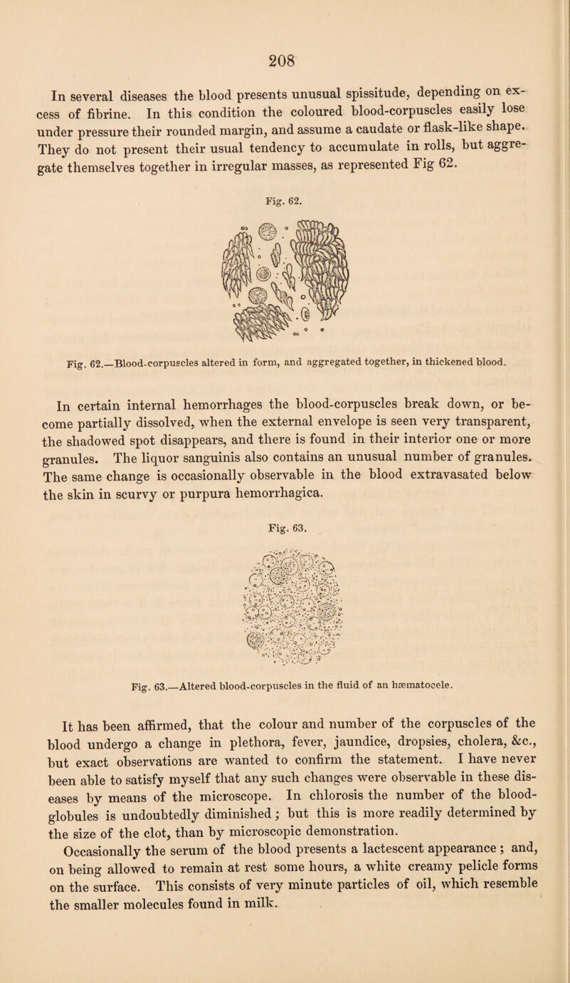 In several diseases the blood presents unusual spissitude, depending on ex¬ cess of fibrine. In this condition the coloured blood-corpuscles easily lose under pressure their rounded margin, and assume a caudate or flask-like shape. They do not present their usual tendency to accumulate in rolls, but aggre¬ gate themselves together in irregular masses, as represented Fig 62. Fig. 62. Fig. 62.—Blood-corpuscles altered in form, and aggregated together, in thickened blood. In certain internal hemorrhages the blood-corpuscles break down, or be¬ come partially dissolved, when the external envelope is seen very transparent, the shadowed spot disappears, and there is found in their interior one or more granules. The liquor sanguinis also contains an unusual number of granules. The same change is occasionally observable in the blood extravasated below the skin in scurvy or purpura hemorrhagica. Fig. 63, Fig. 63.—Altered blood-corpuscles in the fluid of an hsematocele. It has been affirmed, that the colour and number of the corpuscles of the blood undergo a change in plethora, fever, jaundice, dropsies, cholera, &c., but exact observations are wanted to confirm the statement. I have never been able to satisfy myself that any such changes were observable in these dis¬ eases by means of the microscope. In chlorosis the number of the blood- globules is undoubtedly diminished; but this is more readily determined by the size of the clot, than by microscopic demonstration. Occasionally the serum of the blood presents a lactescent appearance ; and, on being allowed to remain at rest some hours, a white creamy pelicle forms on the surface. This consists of very minute particles of oil, which resemble the smaller molecules found in milk.