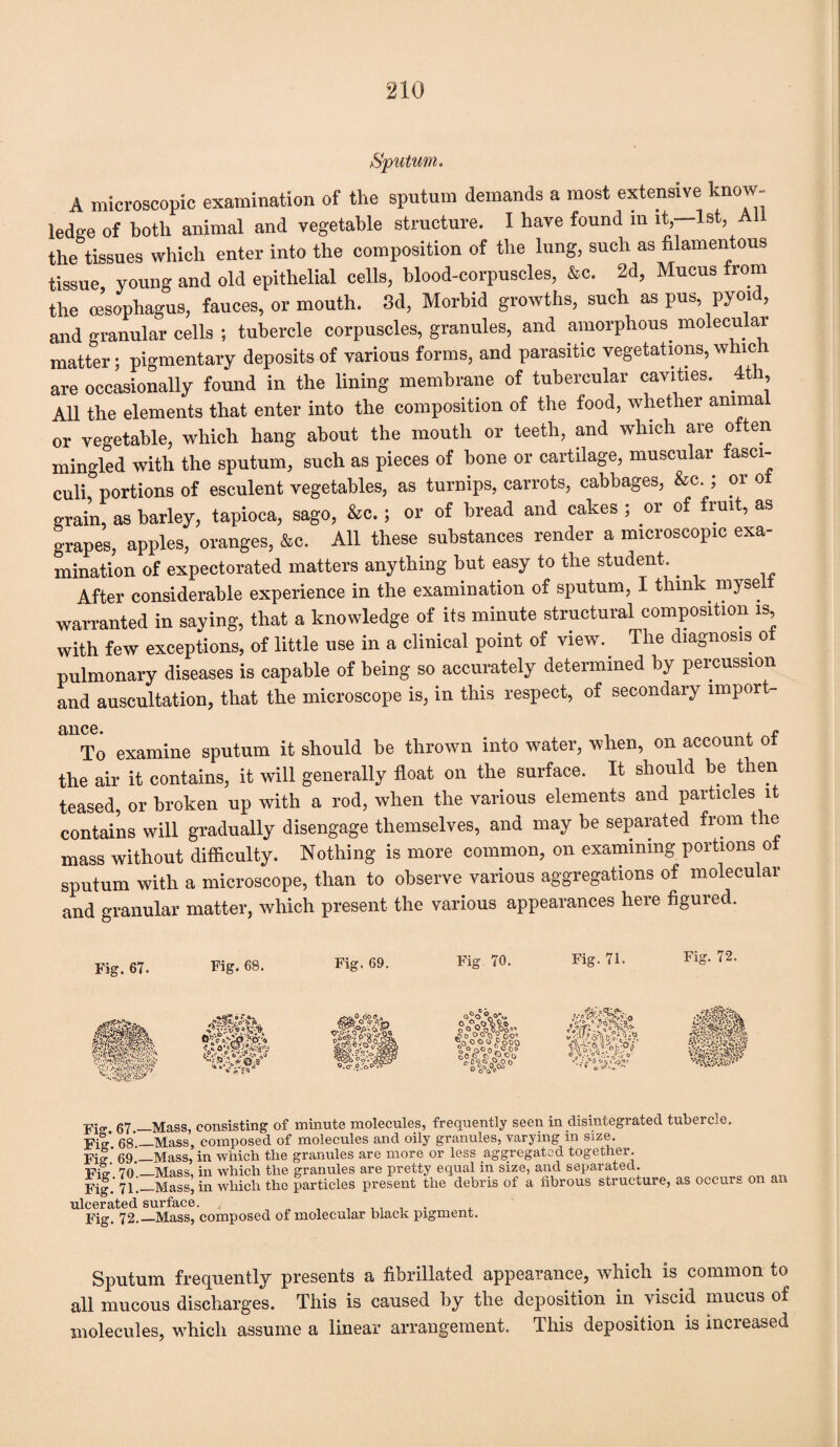 Sputum. A microscopic examination of the sputum demands a most extensive know- ledge of both animal and vegetable structure. I have found m it,—1st, A the tissues which enter into the composition of the lung, such as filamentous tissue, young and old epithelial cells, blood-corpuscles, &c. 2d, Mucus from the oesophagus, fauces, or mouth. 3d, Morbid growths, such as pus, pyoid, and granular cells ; tubercle corpuscles, granules, and amorphous molecular matter; pigmentary deposits of various forms, and parasitic vegetations, which are occasionally found in the lining membrane of tubercular cavities. 4t , All the elements that enter into the composition of the food, whether anima or vegetable, which hang about the mouth or teeth, and which are often mingled with the sputum, such as pieces of bone or cartilage, muscular fasci¬ culi portions of esculent vegetables, as turnips, carrots, cabbages, &c.; or of grain, as barley, tapioca, sago, &c.; or of bread and cakes ; or of fruit, as grapes, apples, oranges, &c. All these substances render a microscopic exa¬ mination of expectorated matters anything but easy to the student.. After considerable experience in the examination of sputum, I think myself warranted in saying, that a knowledge of its minute structural composition is, with few exceptions, of little use in a clinical point of view. The diagnosis of pulmonary diseases is capable of being so accurately determined by percussion and auscultation, that the microscope is, in this respect, of secondary import- &11C6. i n To examine sputum it should be thrown into water, when, on account ot the air it contains, it will generally float on the surface. It should be then teased, or broken up with a rod, when the various elements and particles it contains will gradually disengage themselves, and may be separated from the mass without difficulty. Nothing is more common, on examining portions of sputum with a microscope, than to observe various aggregations of molecular and granular matter, which present the various appearances here figured. Fig. 67. Fig. 68. Fig. 69. Fig 70. Fig. 71. Fig. 72. O-..0-0 Mm , 6 ik?o°e°A0 ■pia- 67_Mass, consisting of minute molecules, frequently seen in disintegrated tuberce. VUr' 68—Mass, composed of molecules and oily granules, varying m size. Fif ’ 69 —Mass, in which tlie granules are more or less aggregated together. Fie 7o‘_Mass, in which the granules are pretty equal in size, and separated. Fig.' 71.—Mass, in which the particles present the debris of a fibrous structure, as occurs on an ulcerated surface. , , Fig. 72._Mass, composed of molecular black pigment. Sputum frequently presents a fibrillated appearance, which is common to all mucous discharges. This is caused by the deposition in viscid mucus of molecules, which assume a linear arrangement. This deposition is increased