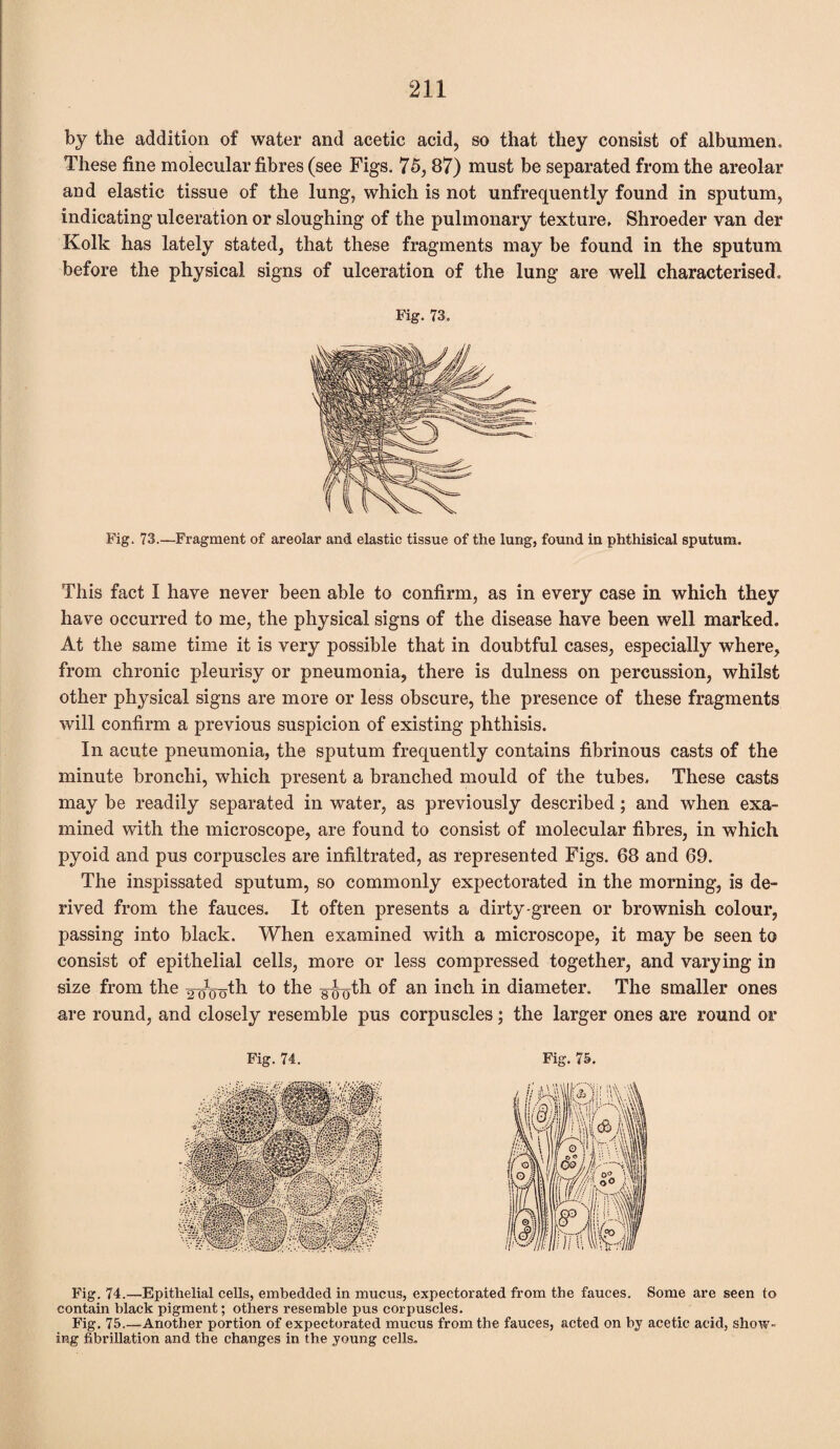 by the addition of water and acetic acid,, so that they consist of albumen. These fine molecular fibres (see Figs. 75, 87) must be separated from the areolar and elastic tissue of the lung, which is not unfrequently found in sputum, indicating ulceration or sloughing of the pulmonary texture. Shroeder van der Kolk has lately stated, that these fragments may be found in the sputum before the physical signs of ulceration of the lung are well characterised. Fig. 73. Fig. 73.—Fragment of areolar and elastic tissue of the lung, found in phthisical sputum. This fact I have never been able to confirm, as in every case in which they have occurred to me, the physical signs of the disease have been well marked. At the same time it is very possible that in doubtful cases, especially where, from chronic pleurisy or pneumonia, there is dulness on percussion, whilst other physical signs are more or less obscure, the presence of these fragments will confirm a previous suspicion of existing phthisis. In acute pneumonia, the sputum frequently contains fibrinous casts of the minute bronchi, which present a branched mould of the tubes. These casts may be readily separated in water, as previously described ; and when exa¬ mined with the microscope, are found to consist of molecular fibres, in which pyoid and pus corpuscles are infiltrated, as represented Figs. 68 and 69. The inspissated sputum, so commonly expectorated in the morning, is de¬ rived from the fauces. It often presents a dirty-green or brownish colour, passing into black. When examined with a microscope, it may be seen to consist of epithelial cells, more or less compressed together, and varying in size from the go^th to the g-j^th °f an inch diameter. The smaller ones are round, and closely resemble pus corpuscles; the larger ones are round or Fig. 74. Fig. 75. Fig. 74.—Epithelial cells, embedded in mucus, expectorated from the fauces. Some are seen to contain black pigment; others resemble pus corpuscles. Fig. 75.—Another portion of expectorated mucus from the fauces, acted on hj acetic acid, show¬ ing fibrillation and the changes in the young cells.