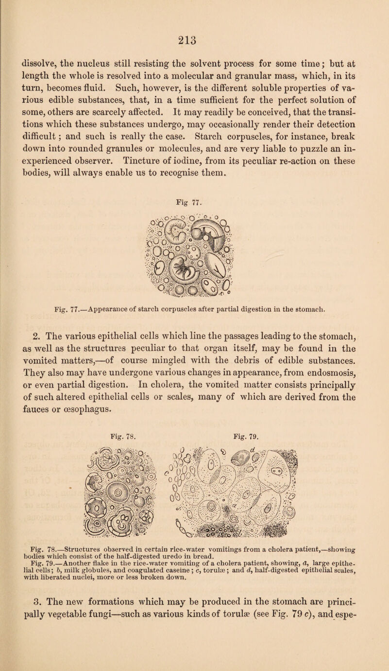 dissolve, the nucleus still resisting the solvent process for some time; but at length the whole is resolved into a molecular and granular mass, which, in its turn, becomes fluid. Such, however, is the different soluble properties of va¬ rious edible substances, that, in a time sufficient for the perfect solution of some, others are scarcely affected. It may readily be conceived, that the transi¬ tions which these substances undergo, may occasionally render their detection difficult; and such is really the case. Starch corpuscles, for instance, break down into rounded granules or molecules, and are very liable to puzzle an in¬ experienced observer. Tincture of iodine, from its peculiar re-action on these bodies, will always enable us to recognise them. Fig 77- Fig. 77.—Appearance of starch corpuscles after partial digestion in the stomach. 2. The various epithelial cells which line the passages leading to the stomach, as well as the structures peculiar to that organ itself, may be found in the vomited matters,—of course mingled with the debris of edible substances. They also may have undergone various changes in appearance, from endosmosis, or even partial digestion. In cholera, the vomited matter consists principally of such altered epithelial cells or scales, many of which are derived from the fauces or oesophagus. Fig. 78. Fig. 79. Fig. 78.—Structures observed in certain rice-water vomitings from a cholera patient,—showing bodies which consist of the half-digested uredo in bread. Fig. 79.—Another flake in the rice-water vomiting of a cholera patient, showing, d, large epithe¬ lial cells; b, milk globules, and coagulated caseine ; c, torulse; and d, half-digested epithelial scales, with liberated nuclei, more or less broken down. 3. The new formations which may be produced in the stomach are princi¬ pally vegetable fungi—such as various kinds of torulae (see Fig. 79 c), and espe-