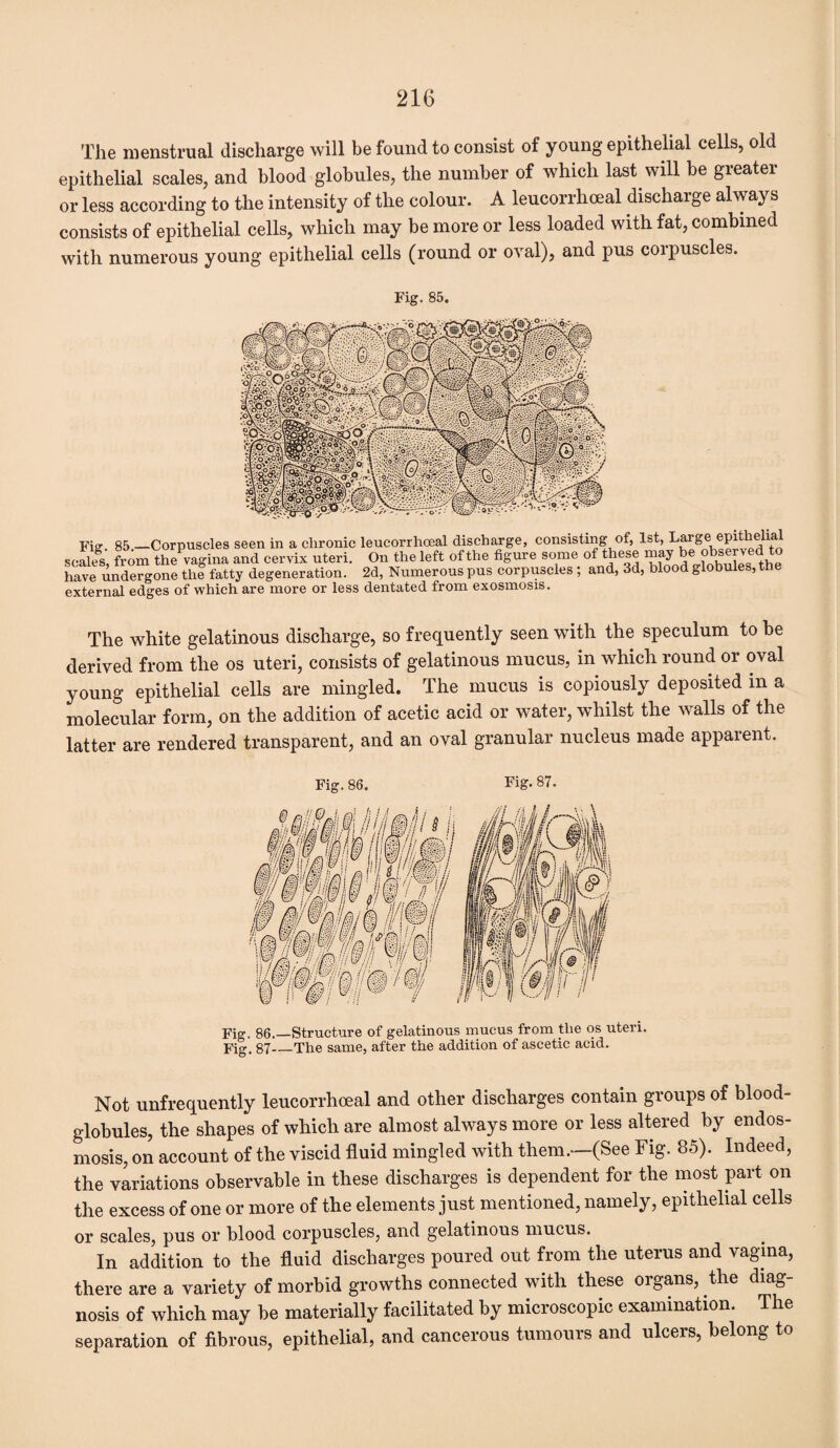 The menstrual discharge will be found to consist of young epithelial cells, old epithelial scales, and blood globules, the number of which last will be greater or less according to the intensity of the colour. A leucorrhceal discharge always consists of epithelial cells, which may be more or less loaded with fat, combined with numerous young epithelial cells (round or oval), and pus corpuscles. Fig. 85. Fig. 85.—Corpuscles seen in a chronic leucorrhceal discharge, consisting of, 1st, Largei epithelial scales, from the vagina and cervix uteri. On the left of the figure some of these may be observed to have undergone the fatty degeneration. 2d, Numerous pus corpuscles ; and, 3d, blood globules, th external edges of which are more or less dentated from exosmosis. The white gelatinous discharge, so frequently seen with the speculum to be derived from the os uteri, consists of gelatinous mucus, in which round or oval young epithelial cells are mingled. The mucus is copiously deposited in a molecular form, on the addition of acetic acid or water, whilst the walls of the latter are rendered transparent, and an oval granular nucleus made apparent. Fig.86. Fig- 87. Fig. 86.—Structure of gelatinous mucus from the os uteri. Fig. 87_The same, after the addition of ascetic acid. Not unfrequently leucorrhoeal and other discharges contain groups of blood- globules, the shapes of which are almost always more or less altered by endos- mosis, on account of the viscid fluid mingled with them.—(See Fig. 85). Indeed, the variations observable in these discharges is dependent for the most part on the excess of one or more of the elements just mentioned, namely, epithelial cells or scales, pus or blood corpuscles, and gelatinous mucus. In addition to the fluid discharges poured out from the uterus and vagina, there are a variety of morbid growths connected with these organs, the diag¬ nosis of which may be materially facilitated by microscopic examination. The separation of fibrous, epithelial, and cancerous tumours and ulcers, belong to