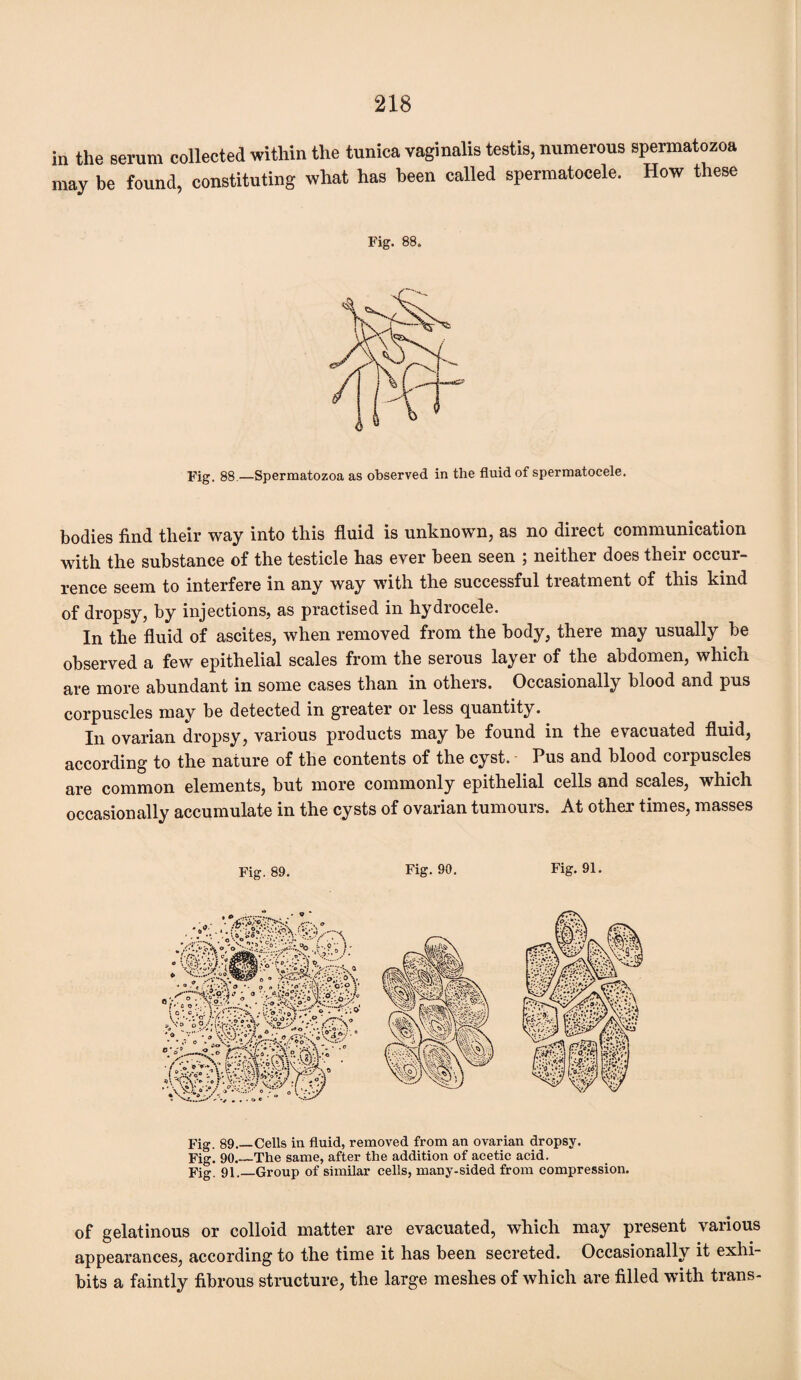 in the serum collected within the tunica vaginalis testis, numerous spermatozoa may be found, constituting what has been called spermatocele. How these Fig. 88. Fig. 88.—Spermatozoa as observed in the fluid of spermatocele. bodies find their way into this fluid is unknown, as no direct communication with the substance of the testicle has ever been seen ; neither does their occur¬ rence seem to interfere in any way with the successful treatment of this kind of dropsy, by injections, as practised in hydrocele. In the fluid of ascites, when removed from the body, there may usually be observed a few epithelial scales from the serous layer of the abdomen, which are more abundant in some cases than in others. Occasionally blood and pus corpuscles may be detected in greater or less quantity. In ovarian dropsy, various products may be found in the evacuated fluid, according to the nature of the contents of the cyst. Pus and blood corpuscles are common elements, but more commonly epithelial cells and scales, which occasionally accumulate in the cysts of ovarian tumours. At other times, masses Fig. 89. Fig. 90. Fig. 91. Fig. 89.—Cells in fluid, removed from an ovarian dropsy. Fig. 90.—The same, after the addition of acetic acid. Fig. 91._Group of similar cells, many-sided from compression. of gelatinous or colloid matter are evacuated, which may present various appearances, according to the time it has been secreted. Occasionally it exhi¬ bits a faintly fibrous structure, the large meshes of which are filled with trans-