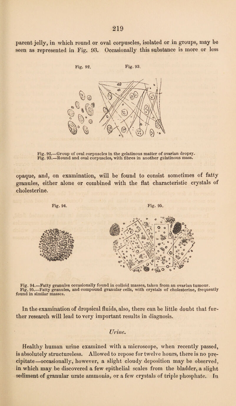 parent jelly, in which round or oval corpuscles, isolated or in groups, may be seen as represented in Fig. 93. Occasionally this substance is more or less Fig. 92. Fig. 93. Fig. 92.—Group of oval corpuscles in the gelatinous matter of ovarian dropsy. Fig. 93.—Round and oval corpuscles, with fibres in another gelatinous mass. opaque, and, on examination, will be found to consist sometimes of fatty granules, either alone or combined with the flat characteristic crystals of cholesterine. Fig. 94. Fig. 95. Fig. 94.—Fatty granules occasionally found in colloid masses, taken from an ovarian tumour. Fig. 95.—Fatty granules, and compound granular cells, with crystals of cholesterine, frequently found in similar masses. In the examination of dropsical fluids, also, there can be little doubt that fur¬ ther research will lead to very important results in diagnosis. Urine. Healthy human urine examined with a microscope, when recently passed, is absolutely structureless. Allowed to repose for twelve hours, there is no pre¬ cipitate—occasionally, however, a slight cloudy deposition may be observed, in which may be discovered a few epithelial scales from the bladder, a slight sediment of granular urate ammonia, or a few crystals of triple phosphate. In