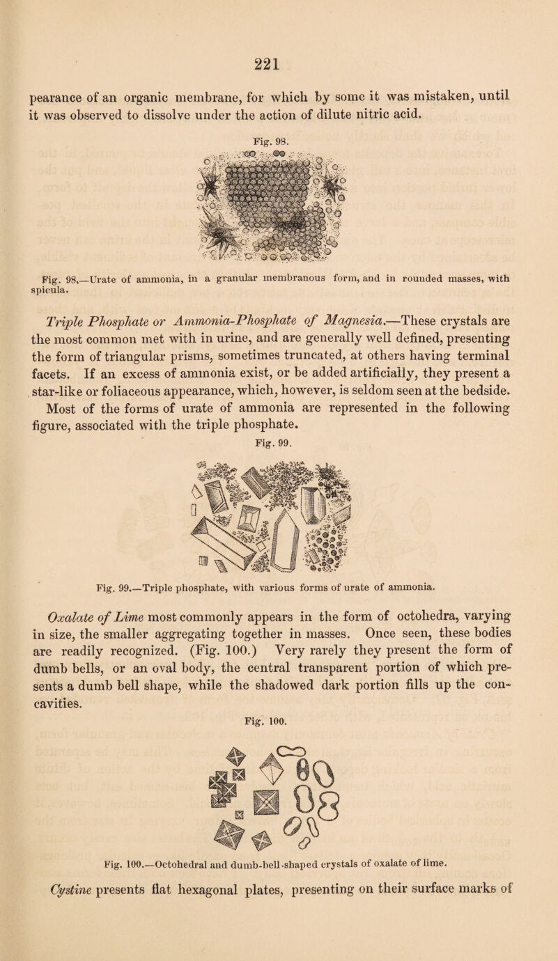 pearance of an organic membrane, for which by some it was mistaken, until it was observed to dissolve under the action of dilute nitric acid. Fig. 98. Fig. 98,_Urate of ammonia, in a granular membranous form, and in rounded masses, with spieula. Triple Phosphate or Ammonia-Phosphate of Magnesia.—These crystals are the most common met with in urine, and are generally well defined, presenting the form of triangular prisms, sometimes truncated, at others having terminal facets. If an excess of ammonia exist, or be added artificially, they present a star-like or foliaceous appearance, which, however, is seldom seen at the bedside. Most of the forms of urate of ammonia are represented in the following figure, associated with the triple phosphate. Fig. 99. Fig. 99.—Triple phosphate, with various forms of urate of ammonia. Oxalate of Lime most commonly appears in the form of octohedra, varying in size, the smaller aggregating together in masses. Once seen, these bodies are readily recognized. (Fig. 100.) Very rarely they present the form of dumb bells, or an oval body, the central transparent portion of which pre¬ sents a dumb bell shape, while the shadowed dark portion fills up the con¬ cavities. Fig. 100. Fig. 100.—Octohedral and dumb-bell-shaped crystals of oxalate of lime. Cystine presents flat hexagonal plates, presenting on their surface marks of