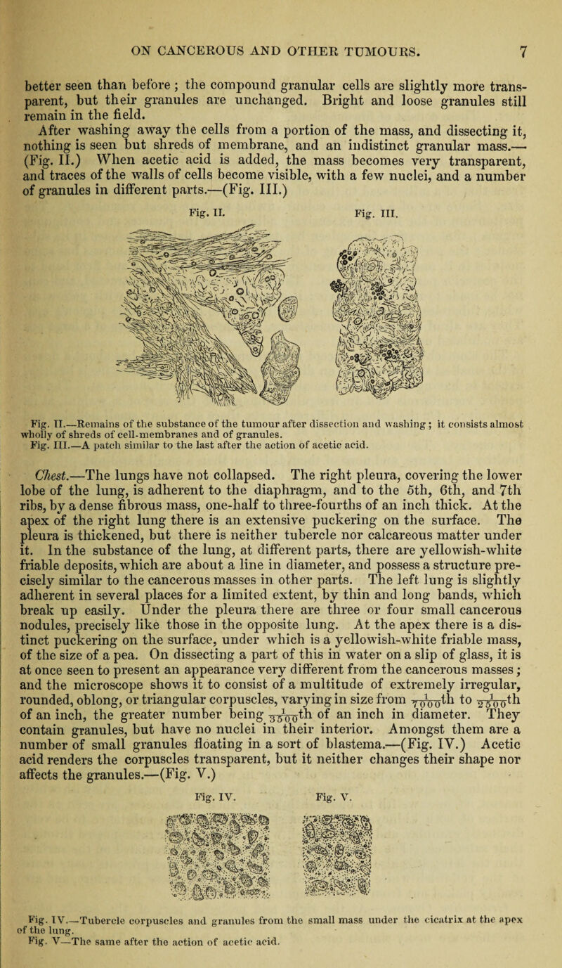 better seen than before ; the compound granular cells are slightly more trans¬ parent, but their granules are unchanged. Bright and loose granules still remain in the field. After washing away the cells from a portion of the mass, and dissecting it, nothing is seen but shreds of membrane, and an indistinct granular mass.— (Fig. II.) When acetic acid is added, the mass becomes very transparent, and traces of the walls of cells become visible, with a few nuclei, and a number of granules in different parts.—(Fig. III.) Fig. II.—Remains of the substance of the tumour after dissection and washing ; it consists almost wholly of shreds of cell-membranes and of granules. Fig. III.—A patch similar to the last after the action of acetic acid. Chest.—The lungs have not collapsed. The right pleura, covering the lower lobe of the lung, is adherent to the diaphragm, and to the 5th, 6th, and 7th ribs, by a dense fibrous mass, one-half to three-fourths of an inch thick. At the apex of the right lung there is an extensive puckering on the surface. The pleura is thickened, but there is neither tubercle nor calcareous matter under it. In the substance of the lung, at different parts, there are yellowish-white friable deposits, which are about a line in diameter, and possess a structure pre¬ cisely similar to the cancerous masses in other parts. The left lung is slightly adherent in several places for a limited extent, by thin and long bands, which break up easily. Under the pleura there are three or four small cancerous nodules, precisely like those in the opposite lung. At the apex there is a dis¬ tinct puckering on the surface, under which is a yellowish-white friable mass, of the size of a pea. On dissecting a part of this in water on a slip of glass, it is at once seen to present an appearance very different from the cancerous masses; and the microscope shows it to consist of a multitude of extremely irregular, rounded, oblong, or triangular corpuscles, varying in size from y-(/0dth to ^th of an inch, the greater number being 3 ^ Qth of an inch in diameter. They contain granules, but have no nuclei in their interior. Amongst them are a number of small granules floating in a sort of blastema.—(Fig. IV.) Acetic acid renders the corpuscles transparent, but it neither changes their shape nor affects the granules.—(Fig. V.) Fig. IV. Fig. v. Fig. IV—Tubercle corpuscles and granules from the small mass under the cicatrix at the apex of the lung. Fig. V—The same after the action of acetic acid.