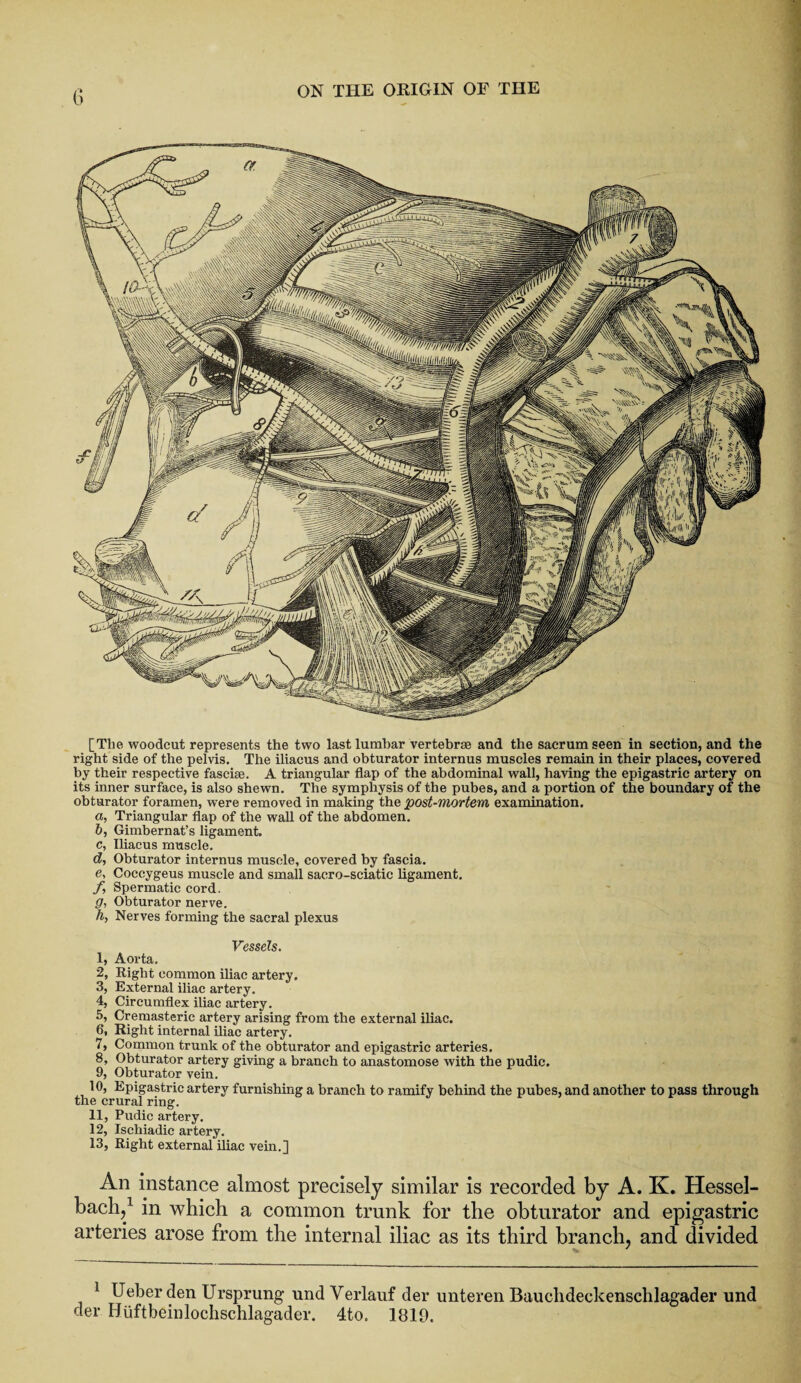 vmrmms- liilmiiiMnii/. [The woodcut represents the two last lumbar vertebrae and the sacrum seen in section, and the right side of the pelvis. The iliacus and obturator internus muscles remain in their places, covered by their respective fasciae. A triangular flap of the abdominal wall, having the epigastric artery on its inner surface, is also shewn. The symphysis of the pubes, and a portion of the boundary of the obturator foramen, were removed in making the post-mortem, examination. а, Triangular flap of the wall of the abdomen. б, Gimbernat’s ligament. c, Iliacus muscle. d, Obturator internus muscle, covered by fascia. e, Coccygeus muscle and small sacro-sciatic ligament. f Spermatic cord. g, Obturator nerve. h, Nerves forming the sacral plexus Vessels. 1, Aorta. 2, Right common iliac artery. 3, External iliac artery. 4, Circumflex iliac artery. 5, Cremasteric artery arising from the external iliac. 6, Right internal iliac artery. 7, Common trunk of the obturator and epigastric arteries. 8, Obturator artery giving a branch to anastomose with the pudic. 9, Obturator vein. 10, Epigastric artery furnishing a branch to ramify behind the pubes, and another to pass through the crural ring. 11, Pudic artery. 12, Ischiadic artery. 13, Right external iliac vein.] An instance almost precisely similar is recorded by A. K. Hessel- bach,1 in which a common trunk for the obturator and epigastric arteries arose from the internal iliac as its third branch, and divided 1 Ueber den Ursprung und Verlauf der unteren Bauclideckensclilagader und der Huftbeinlochschlagader. 4to. 1819.