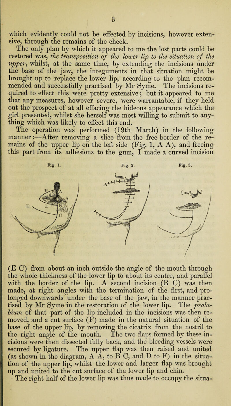 which evidently could not be effected by incisions, however exten¬ sive, through the remains of the cheek. The only plan by which it appeared to me the lost parts could be restored was, the transposition of the lower lip to the situation of the upper, whilst, at the same time, by extending the incisions under the base of the jaw, the integuments in that situation might be brought up to replace the lower lip, according to the plan recom¬ mended and successfully practised by Mr Syme. The incisions re¬ quired to effect this were pretty extensive; but it appeared to me that any measures, however severe, were warrantable, if they held out the prospect of at all effacing the hideous appearance which the girl presented, whilst she herself was most willing to submit to any¬ thing which was likely to effect this end. The operation was performed (19th March) in the following manner:—After removing a slice from the free border of the re¬ mains of the upper lip on the left side (Fig. 1, A A), and freeing this part from its adhesions to the gum, I made a curved incision (E C) from about an inch outside the angle of the mouth through the whole thickness of the lower lip to about its centre, and parallel with the border of the lip. A second incision (B C) was then made, at right angles with the termination of the first, and pro¬ longed downwards under the base of the jaw, in the manner prac¬ tised by Mr Syme in the restoration of the lower lip. The prola¬ bium of that part of the lip included in the incisions was then re¬ moved, and a cut surface (F) made in the natural situation of the base of the upper lip, by removing the cicatrix from the nostril to the right angle of the mouth. The two flaps formed by these in- J cisions were then dissected fully back, and the bleeding vessels were secured by ligature. The upper flap was then raised and united (as shown in the diagram, A A, to B C, and D to F) in the situa- I tion of the upper lip, whilst the lower and larger flap was brought up and united to the cut surface of the lower lip and chin. The right half of the lower lip was thus made to occupy the situa- Fig. 1. Fig. 2. Fig. 3.