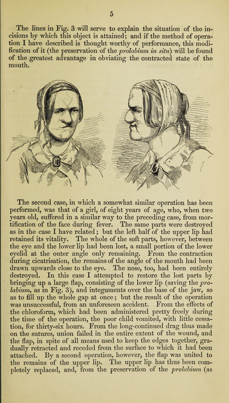 The lines in Fig. 3 will serve to explain the situation of the in¬ cisions by which this object is attained; and if the method of opera¬ tion I have described is thought worthy of performance, this modi¬ fication of it (the preservation of the prolabium in situ) will be found of the greatest advantage in obviating the contracted state of the mouth. The second case, in which a somewhat similar operation has been performed, was that of a girl, of eight years of age, who, when two years old, suffered in a similar way to the preceding case, from mor¬ tification of the face during fever. The same parts were destroyed as in the case I have related; but the left half of the upper lip had retained its vitality. The whole of the soft parts, however, between the eye and the lower lip had been lost, a small portion of the lower eyelid at the outer angle only remaining. From the contraction during cicatrisation, the remains of the angle of the mouth had been drawn upwards close to the eye. The nose, too, had been entirely destroyed. In this case I attempted to restore the lost parts by bringing up a large flap, consisting of the lower lip (saving the pro¬ labium, as in Fig. 3), and integuments over the base of the jaw, so as to fill up the whole gap at once; but the result of the operation was unsuccessful, from an unforeseen accident. From the effects of the chloroform, which had been administered pretty freely during the time of the operation, the poor child vomited, with little cessa¬ tion, for thirty-six hours. From the long-continued drag thus made on the sutures, union failed in the entire extent of the wound, and the flap, in spite of all means used to keep the edges together, gra¬ dually retracted and receded from the surface to which it had been attached. By a second operation, however, the flap was united to the remains of the upper lip. The upper lip has thus been com¬ pletely replaced, and, from the preservation of the prolabium (as