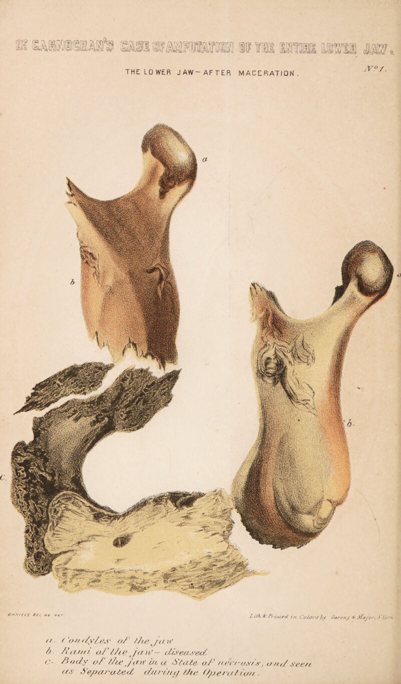 THE: LOWER JAW-AFTER MACERATION. JV°J. EtA/utti' Dej. ao Zj ilh. Sc Pfi/ilcd in Ca tors by Suren y & J/Lctjor, .4 )o <r. ('onftyl.es oZ' the jaw b Zatt/tr oZ l/ie ja W— diseased C- Zody oZ die jaw in. a State oZ‘ necrosis, a ad seen as Separated during die Op era l/on ■