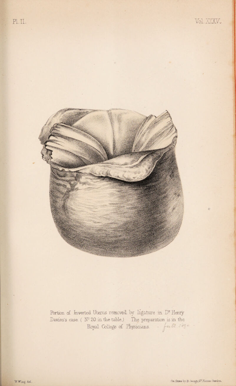 Pl.II. Yoi.miL Portion c£ JnvertecL Uterus remove cL Ly ligature in Dx Henry Davies's case. ( H° 20 in the table.) TLe preparation is m the Loyal College of PLysicians. W.Wmg. del On Stone bvB. George,47 .Hair on. Garden.