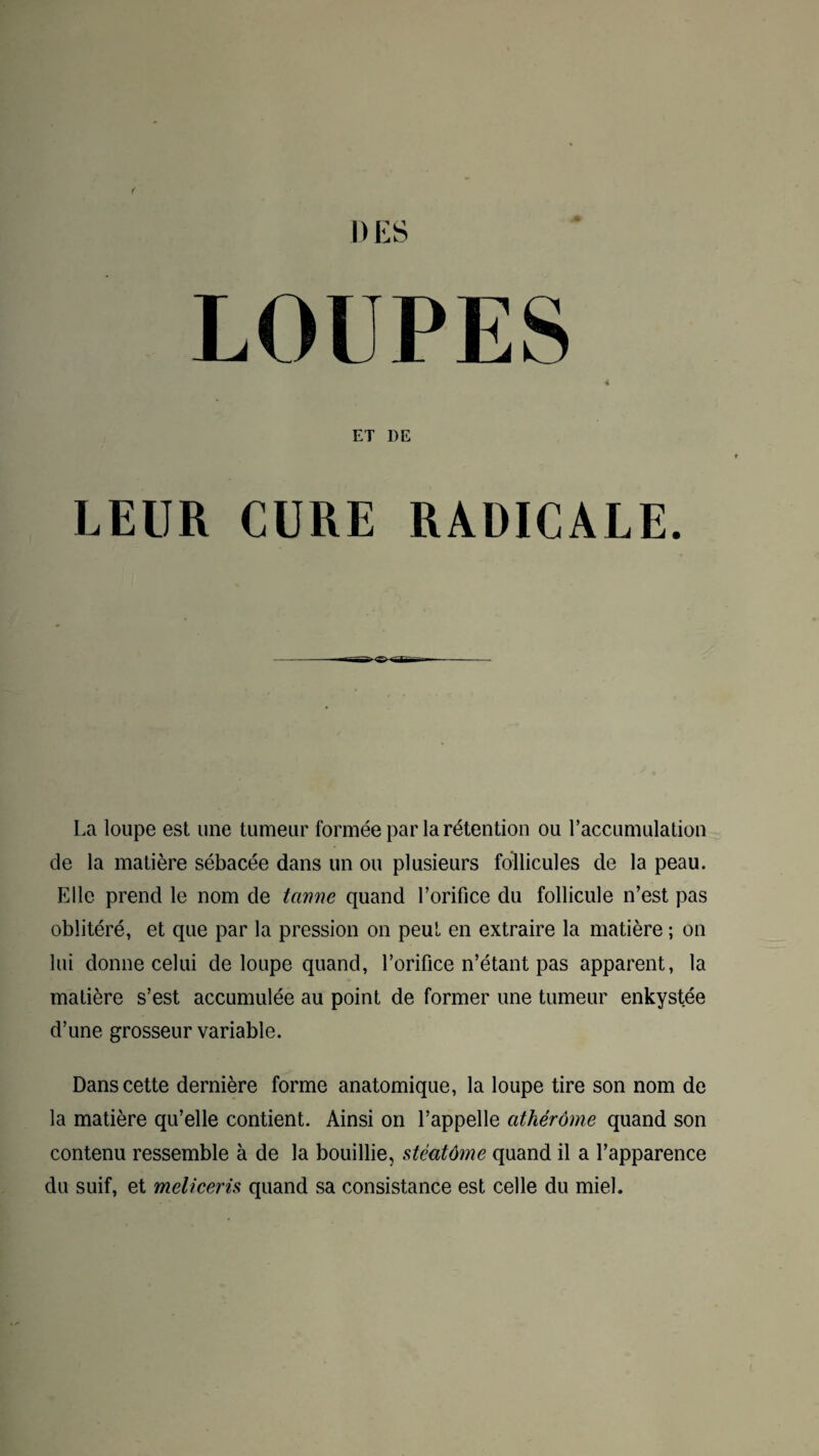LOUPES 4 ET DE LEUR CURE RADICALE. La loupe est une tumeur formée par la rétention ou l’accumulation de la matière sébacée dans un ou plusieurs follicules de la peau. Elle prend le nom de tanne quand l’orifice du follicule n’est pas oblitéré, et que par la pression on peut en extraire la matière ; on lui donne celui de loupe quand, l’orifice n’étant pas apparent, la matière s’est accumulée au point de former une tumeur enkystée d’une grosseur variable. Dans cette dernière forme anatomique, la loupe tire son nom de la matière qu’elle contient. Ainsi on l’appelle athérôme quand son contenu ressemble à de la bouillie, stéatôme quand il a l’apparence du suif, et méliceris quand sa consistance est celle du miel.