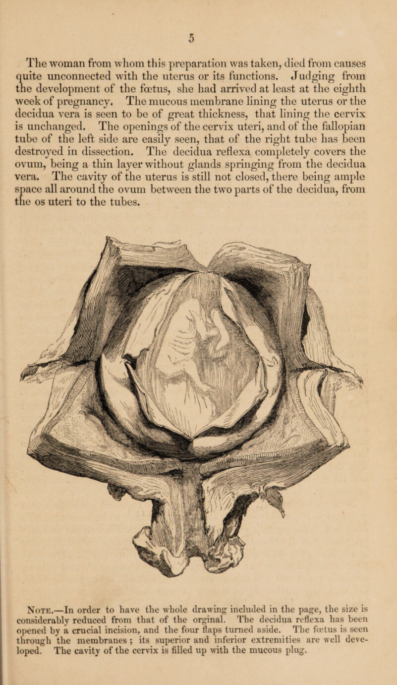 The woman from whom this preparation was taken, died from causes quite unconnected with the uterus or its functions. Judging from the development of the foetus, she had arrived at least at the eighth week of pregnancy. The mucous membrane lining the uterus or the decidua vera is seen to be of great thickness, that lining the cervix is unchanged. The openings of the cervix uteri, and of the fallopian tube of the left side are easily seen, that of the right tube has been destroyed in dissection. The decidua reflexa completely covers the ovum, being a thin layer without glands springing from the decidua vera. The cavity of the uterus is still not closed, there being ample space all around the ovum between the two parts of the decidua, from the os uteri to the tubes. Note.—In order to have the whole drawing included in the page, the size is considerably reduced from that of the orginal. The decidua reflexa has been opened by a crucial incision, and the four flaps turned aside. The foetus is seen through the membranes ; its superior and inferior extremities are well deve¬ loped. The cavity of the cervix is filled up with the mucous plug.