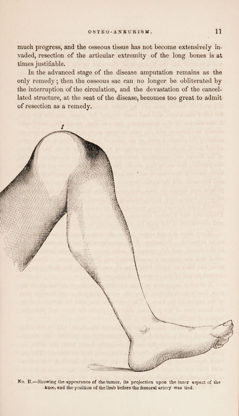 much progress, and the osseous tissue has not become extensively in¬ vaded, resection of the articular extremity of the long bones is at times justifiable. In the advanced stage of the disease amputation remains as the only remedy; then the osseous sac can no longer be obliterated by the interruption of the circulation, and the devastation of the cancel¬ lated structure, at the seat of the disease, becomes too great to admit of resection as a remedy. No. II. -Showing the appearance of the tumor, its projection upon the inner- aspect of the knee, and the position of the limb before the femoral artery was tied.