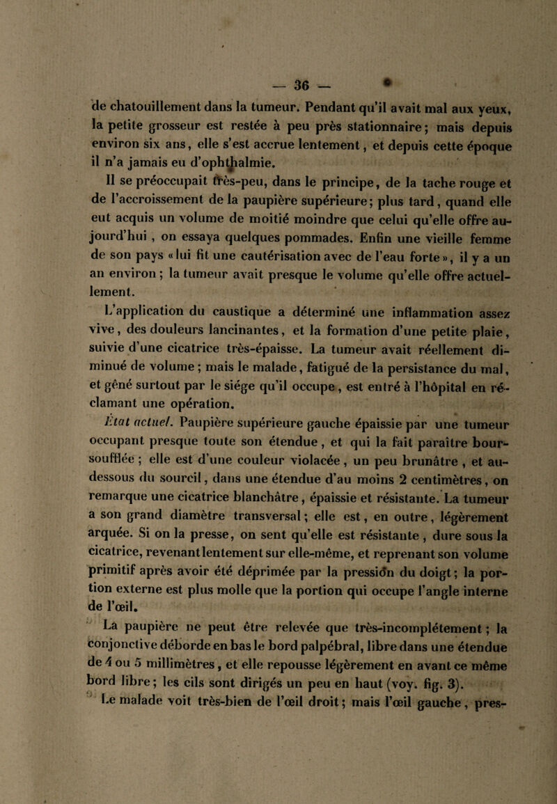 de chatouillement dans la tumeur. Pendant qu il avait mal aux yeux, la petite grosseur est restée à peu près stationnaire ; mais depuis environ six ans, elle s’est accrue lentement, et depuis cette époque il n’a jamais eu d’ophtjialmie. Il se préoccupait frès-peu, dans le principe, de la tache rouge et de l’accroissement de la paupière supérieure; plus tard, quand elle eut acquis un volume de moitié moindre que celui qu’elle offre au¬ jourd’hui , on essaya quelques pommades. Enfin une vieille femme de son pays « lui fit une cautérisation avec de l’eau forte», il y a un an environ ; la tumeur avait presque le volume qu’elle offre actuel¬ lement. L’application du caustique a déterminé une inflammation assez vive, des douleurs lancinantes, et la formation d’une petite plaie, suivie d’une cicatrice très-épaisse. La tumeur avait réellement di¬ minué de volume ; mais le malade, fatigué de la persistance du mal, et gêné surtout par le siège qu’il occupe, est entré à l’hôpital en ré¬ clamant une opération. Etat actuel. Paupière supérieure gauche épaissie par une tumeur occupant presque toute son étendue, et qui la fait paraître bour- souffiée ; elle est^i’une couleur violacée, un peu brunâtre , et au- dessous du sourcil, dans une étendue d’au moins 2 centimètres, on remarque une cicatrice blanchâtre, épaissie et résistante. La tumeur a son grand diamètre transversal ; elle est, en outre, légèrement arquée. Si on la presse, on sent qu’elle est résistante , dure sous la cicatrice, revenantlentement sur elle-même, et reprenant son volume primitif après avoir été déprimée par la pressidn du doigt ; la por¬ tion externe est plus molle que la portion qui occupe l’angle interne de l’œil. La paupière ne peut être relevée que très-incomplètement ; la conjonctive déborde en bas le bord palpébral, libre dans une étendue de 4 ou 5 millimètres, et elle repousse légèrement en avant ce même bord libre; les cils sont dirigés un peu en haut (voy. fig. 3). Le malade voit très-bien de l’œil droit; mais l’œil gauche, près-