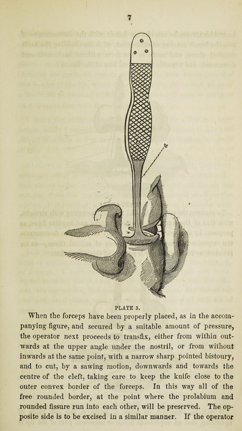 PLATE 3. When the forceps have been properly placed, as in the accom¬ panying figure, and secured by a suitable amount of pressure, the operator next proceeds to transfix, either from within out¬ wards at the upper angle under the nostril, or from without inwards at the same point, wTith a narrow sharp pointed bistoury, and to cut, by a sawing motion, downwards and towards the centre of the cleft, taking care to keep the knife close to the outer convex border of the forceps. In this wray all of the free rounded border, at the point where the prolabium and rounded fissure run into each other, will be preserved. The op¬ posite side is to be excised in a similar manner. If the operator
