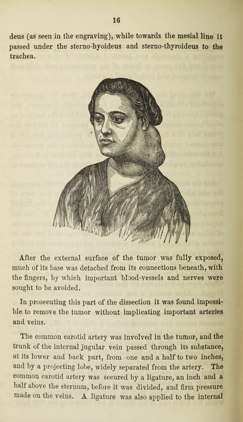 deus (as seen in the engraving), while towards the mesial line it passed under the sterno-hyoideus and sterno-thyroideus to the trachea. After the external surface of the tumor was fully exposed, much of its base was detached from its connections beneath, with the fingers, by which important blood-vessels and nerves were sought to be avoided. In prosecuting this part of the dissection it was found impossi¬ ble to remove the tumor without implicating important arteries and veins. The common carotid artery was involved in the tumor, and the trunk of the internal jugular vein passed through its substance, at its lower and back part, from one and a half to two inches, and by a projecting lobe, widely separated from the artery. The common carotid artery was secured by a ligature, an inch and a halt above the sternum, before it was divided, and firm pressure made on the veins. A ligature was also applied to the internal