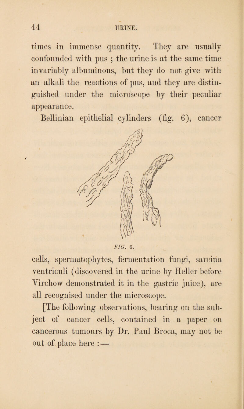 times in immense quantity. They are usually confounded with pus ; the urine is at the same time invariably albuminous, but they do not give with an alkali the reactions of pus, and they are distin¬ guished under the microscope by their peculiar appearance. Bellinian epithelial cylinders (fig. 6), cancer FIG. 6, cells, spermatophytes, fermentation fungi, sarcina ventriculi (discovered in the urine by Heller before Virchow demonstrated it in the gastric juice), are all recognised under the microscope. [The following observations, bearing on the sub¬ ject of cancer cells, contained in a paper on cancerous tumours by Dr. Paul Broca, may not be out of place here :—-