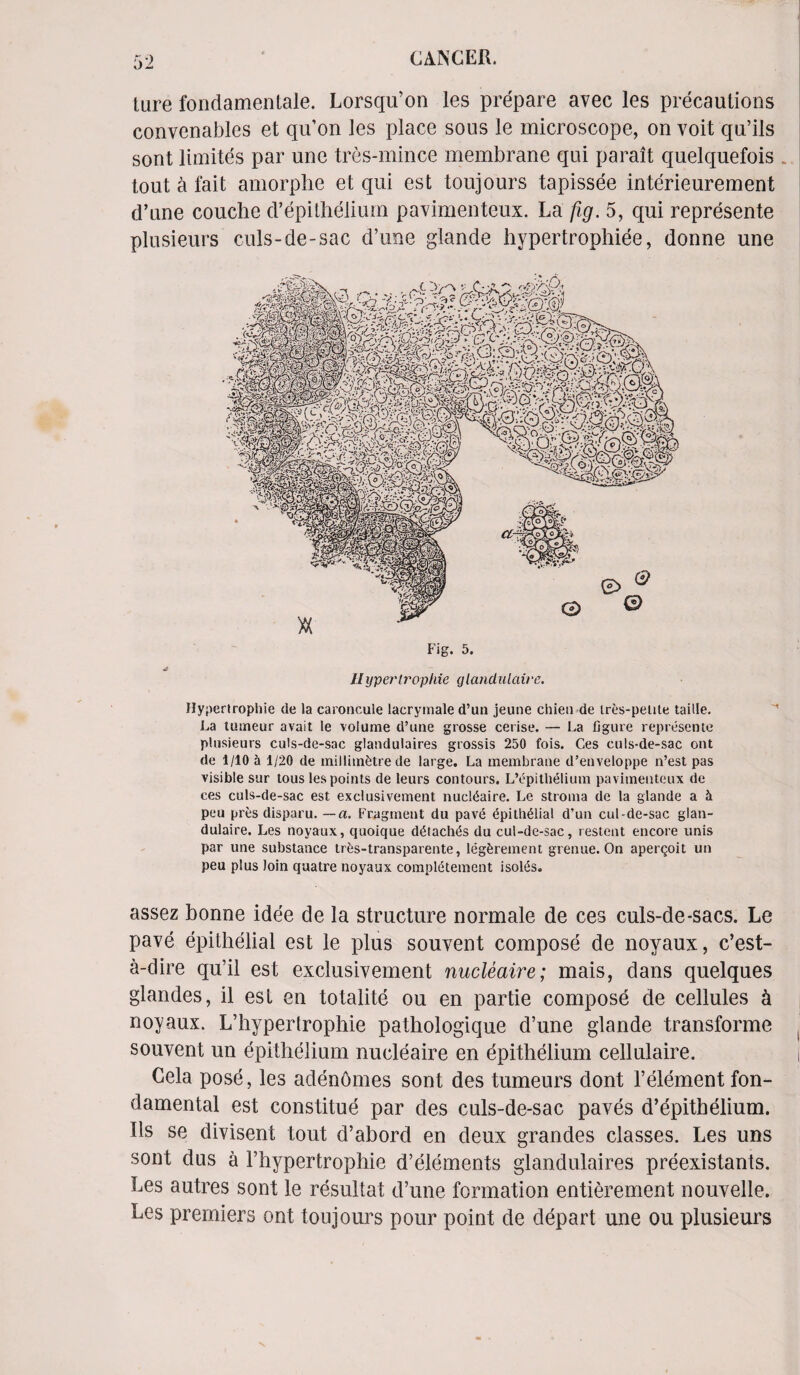 lure fondamentale. Lorsqu’on les prepare avec les precautions convenables et qu’on Jes place sous le microscope, on voit qu’ils sont limites par une tres-mince membrane qui parait quelquefois . tout a fait amorphe et qui est toujours tapissee interieurement d’une couche d’epithelium pavimenteux. La fig. 5, qui represente plusieurs culs-de-sac d’une glande hypertrophiee, donne une Fig. 5. 4* Uypertrophie glandulaire. Hypertrophie (le la caroncule lacrymale d’un jeune chien de tres-petite taille. La tumeur avait le volume d’une grosse cerise. — La figure represente plusieurs culs-de-sac glandulaires grossis 250 fois. Ces culs-de-sac out de i/10 a 1/20 de millimetre de large. La membrane d’enveloppe n’est pas visible sur tous les points de leurs contours. L’L*pilhelium pavimenteux de ces culs-de-sac est exclusivement nucleaire. Le stroma de la glande a & pen pres disparu. — a. Fragment du pav6 6pith61ial d’un cul-de-sac glan¬ dulaire. Les noyaux, quoique d^tach^s du cul-de-sac, restent encore unis par une substance trfcs-transparente, legfcrement grenue. On apergoit un peu plus loin quatre noyaux compl^temcnt isolsis. assez bonne idee de la structure normale de ces culs-de-sacs. Le pave epithelial est le plus souvent compose de noyaux, c’est- a-dire qu’il est exclusivement nucleaire; mais, dans quelques glandes, il est en totalite ou en par tie compose de cellules h noyaux. L’hypertrophie pathologique d’une glande transforme souvent un epithelium nucleaire en epithelium cellulaire. Cela pose, les adenomes sont des tumeurs dont 1’element fon- damental est constitue par des culs-de-sac paves d’epithelium. Ils se divisent tout d’abord en deux grandes classes. Les uns sont dus a l’hypertrophie d’elements glandulaires preexistants. Les autres sont le resultat d’une formation entierement nouvelle. Les premiers ont toujours pour point de depart une ou plusieurs