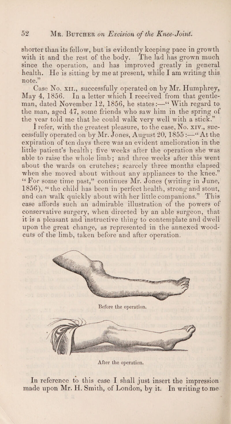 shorter than its fellow, but is evidently keeping pace in growth with it and the rest of the body. The lad has grown much since the operation, and has improved greatly in general health. He is sitting by me at present, while I am writing this note.” Case No. xn., successfully operated on by Mr. Humphrey, May 4, 1856. In a letter which I received from that gentle¬ man, dated November 12, 1856, he states:—“With regard to the man, aged 47, some friends who saw him in the spring of the year told me that he could walk very well with a stick.” I refer, with the greatest pleasure, to the case, No. xiv., suc¬ cessfully operated on by Mr. Jones, August 20, 1855 :—“At the expiration of ten days there was an evident amelioration in the little patient’s health; five weeks after the operation she was able to raise the whole limb; and three weeks after this went about the wards on crutches; scarcely three months elapsed when she moved about without any appliances to the knee.” “For some time past,” continues Mr. Jones (writing in June, 1856), “ the child has been in perfect health, strong and stout, and can walk quickly about with her little companions.” This case affords such an admirable illustration of the powers of conservative surgery, when directed by an able surgeon, that it is a pleasant and instructive tiling to contemplate and dwell upon the great change, as represented in the annexed wood- cuts of the limb, taken before and after operation. Before the operation. After the operation. In reference to this case I shall just insert the impression made upon Mr. H. Smith, of London, by it. In writing to me