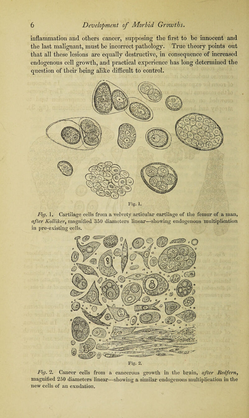 inflammation and others cancer, supposing the first to be innocent and the last malignant, must be incorrect pathology. True theory points out that all these lesions are equally destructive, in consequence of increased endogenous cell growth, and practical experience has long determined the question of their being alike difficult to control. Fig. 1. Fig. 1. Cartilage cells from a velvety articular cartilage of the femur of a man, after Kolliker, magnified 350 diameters linear—showing endogenous multiplication in pre-existing cells. Fig. 2. Fig. 2. Cancer cells from a cancerous growth in the brain, after Bedfern, magnified 250 diameters linear—showing a similar endogenous multiplication in the new cells of an exudation.