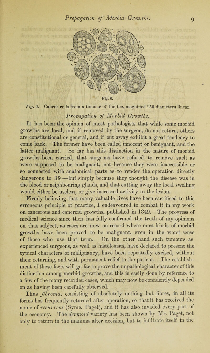 Fig. 6. Cancer cells from a tumour of the toe, magnified 250 diameters linear. Propagation of Morbid Growths. It has been the opinion of most pathologists that while some morbid growths are local, and if removed by the surgeon, do not return, others are constitutional or general, and if cut away exhibit a great tendency to come back. The former have been called innocent or benignant, and the latter malignant. So far has this distinction in the nature of morbid growths been carried, that surgeons have refused to remove such as were supposed to be malignant, not because they were inaccessible or so connected with anatomical parts as to render the operation directly dangerous to life—but simply because they thought the disease was in the blood or neighbouring glands, and that cutting away the local swelling would either be useless, or give increased activity to the lesion. Firmly believing that many valuable lives have been sacrificed to this erroneous principle of practice, I endeavoured to combat it in my work on cancerous and cancroid growths, published in 1849. The progress of medical science since then has fully confirmed the truth of my opinions on that subject, as cases are now on record where most kinds of morbid growths have been proved to be malignant, even in the worst sense of those who use that term. On the other hand such tumours as experienced surgeons, as well as histologists, have declared to present the typical characters of malignancy, have been repeatedly excised, without their returning, and with permanent relief to the patient. The establish¬ ment of these facts will go far to prove the unpathological character of this distinction among morbid growths, and this is easily done by reference to a few of the many recorded cases, which may now be confidently depended on as having been carefully observed. Thus fibroma, consisting of absolutely nothing but fibres, in all its forms has frequently returned after operation, so that it has received the name of recurrent (Syme, Paget), and it has also invaded every part of the economy. The dermoid variety has been shown by Mr. Paget, not only to return in the mamma after excision, but to infiltrate itself in the