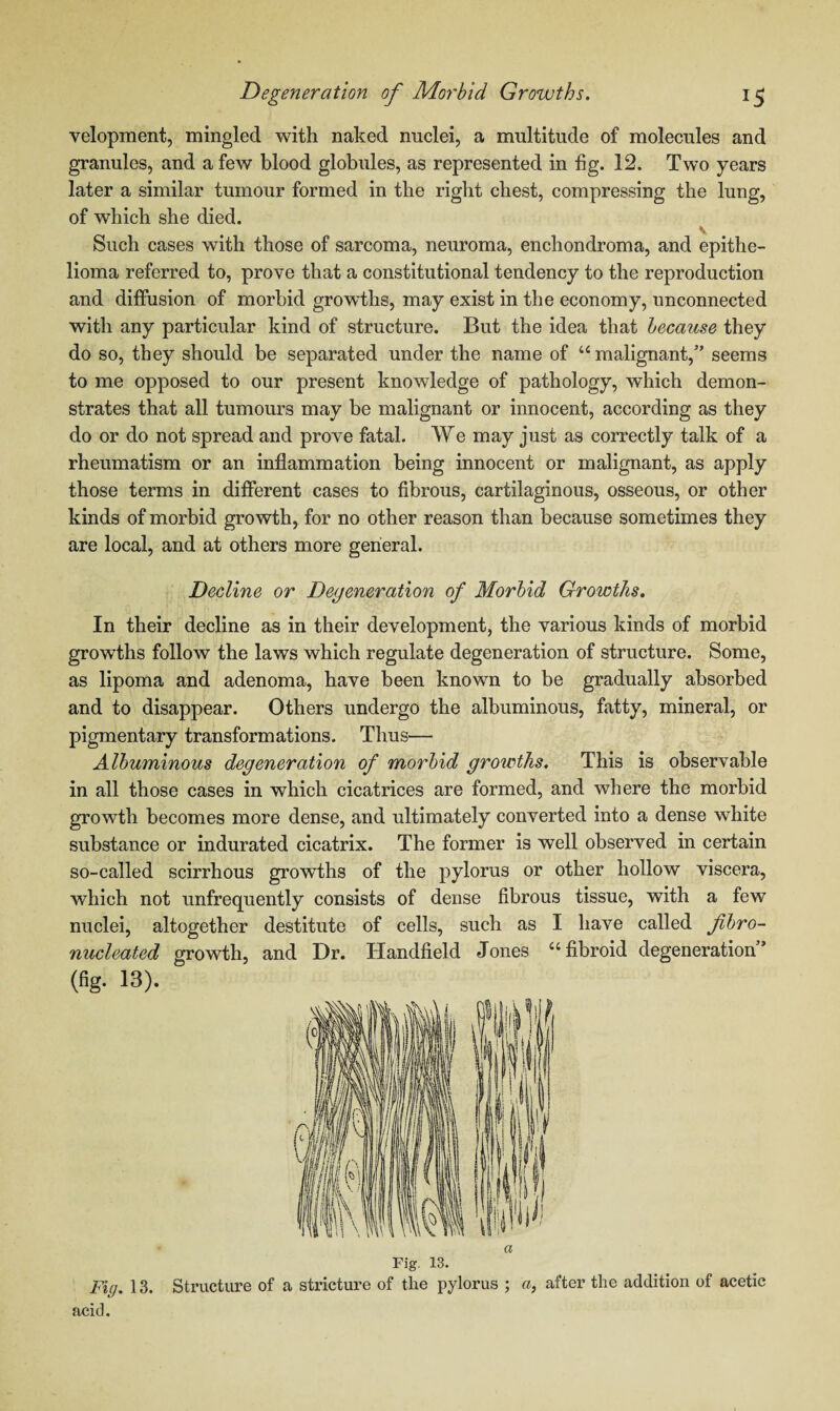 velopment, mingled with naked nuclei, a multitude of molecules and granules, and a few blood globules, as represented in fig. 12. Two years later a similar tumour formed in the right chest, compressing the lung, of which she died. V Such cases with those of sarcoma, neuroma, enchondroma, and epithe¬ lioma referred to, prove that a constitutional tendency to the reproduction and diffusion of morbid growths, may exist in the economy, unconnected with any particular kind of structure. But the idea that because they do so, they should be separated under the name of “malignant,” seems to me opposed to our present knowledge of pathology, which demon¬ strates that all tumours may be malignant or innocent, according as they do or do not spread and prove fatal. We may just as correctly talk of a rheumatism or an inflammation being innocent or malignant, as apply those terms in different cases to fibrous, cartilaginous, osseous, or other kinds of morbid growth, for no other reason than because sometimes they are local, and at others more general. Decline or Degeneration of Morbid Growths. In their decline as in their development, the various kinds of morbid growths follow the laws which regulate degeneration of structure. Some, as lipoma and adenoma, have been known to be gradually absorbed and to disappear. Others undergo the albuminous, fatty, mineral, or pigmentary transformations. Thus— Albuminous degeneration of morbid growths. This is observable in all those cases in which cicatrices are formed, and where the morbid growth becomes more dense, and ultimately converted into a dense white substance or indurated cicatrix. The former is well observed in certain so-called scirrhous growths of the pylorus or other hollow viscera, which not unfrequently consists of dense fibrous tissue, with a few nuclei, altogether destitute of cells, such as I have called fibro- nucleated growth, and Dr. Handheld Jones “fibroid degeneration” (fig. 13). a Fig. 13. Fig. 13. Structure of a stricture of the pylorus ; a, after the addition of acetic acid.