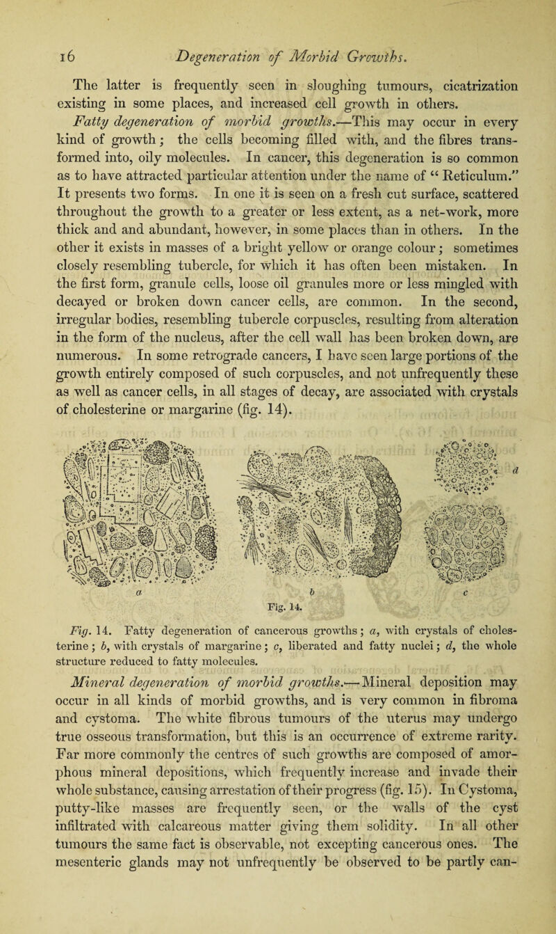 The latter is frequently seen in sloughing tumours, cicatrization existing in some places, and increased cell growth in others. Fatty degeneration of morbid growths.—This may occur in every kind of growth; the cells becoming filled with, and the fibres trans¬ formed into, oily molecules. In cancer, this degeneration is so common as to have attracted particular attention under the name of “ Reticulum. It presents two forms. In one it is seen on a fresh cut surface, scattered throughout the growth to a greater or less extent, as a net-work, more thick and and abundant, however, in some places than in others. In the other it exists in masses of a bright yellow or orange colour; sometimes closely resembling tubercle, for which it has often been mistaken. In the first form, granule cells, loose oil granules more or less mingled with decayed or broken down cancer cells, are common. In the second, irregular bodies, resembling tubercle corpuscles, resulting from alteration in the form of the nucleus, after the cell wall has been broken down, are numerous. In some retrograde cancers, I have seen large portions of the growth entirely composed of such corpuscles, and not unfrequently these as well as cancer cells, in all stages of decay, are associated with crystals of cholesterine or margarine (fig. 14). a be Fig. 14. Fig. 14. Fatty degeneration of cancerous growths; a, with crystals of choles¬ terine ; b, with crystals of margarine; c, liberated and fatty nuclei; d, the whole structure reduced to fatty molecules. Mineral degeneration of morbid growths.•—Mineral deposition may occur in all kinds of morbid growths, and is very common in fibroma and cystoma. The white fibrous tumours of the uterus may undergo true osseous transformation, but this is an occurrence of extreme raritv. Far more commonly the centres of such growths are composed of amor¬ phous mineral depositions, which frequently increase and invade their whole substance, causing arrestation of their progress (fig. 15). In Cystoma, putty-like masses are frequently seen, or the walls of the cyst infiltrated with calcareous matter giving them solidity. In all other tumours the same fact is observable, not excepting cancerous ones. The mesenteric glands may not unfrequently be observed to be partly can-