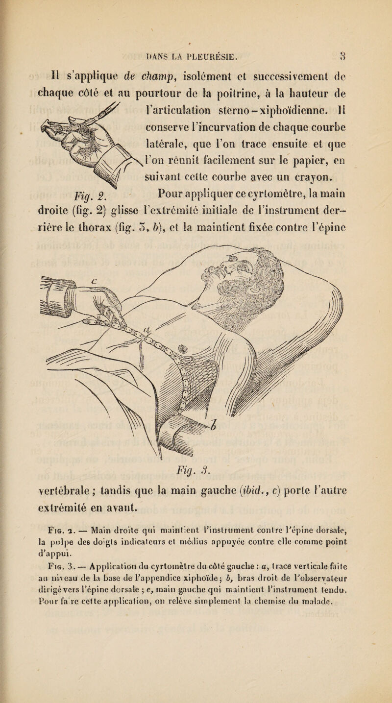 Il s’applique de champ, isolément et successivement de chaque côté et au pourtour de la poitrine, à la hauteur de l’articulation stérno-xiphoïdienne. Il conserve l’incurvation de chaque courbe latérale, que l’on trace ensuite et que l’on réunit facilement sur le papier, en suivant cette courbe avec un crayon. Pour appliquer ce cyrlomètre, la main droite (fig. 2) glisse l’extrémité initiale de l’instrument der¬ rière le thorax (fig. 3, b), et la maintient fixée contre l’épine Fig. 2. Fig. 3. vertébrale; tandis que la main gauche (ibid.f c) porte l’autre extrémité en avant. Fig. a. — Main droite qui maintient l’instrument contre l'épine dorsale, la pulpe des doigts indicateurs et médius appuyée contre elle comme point d’appui. Fig. 3. — Application du cyrtomèlre du côté gauche : a, trace verticale faite au niveau de la base de l’appendice xiphoïde; b, bras droit de l'observateur dirigé vers l’épine dorsale ; c, main gauche qui maintient l’instrument tendu. Pour fa re cette application, on relève simplement la chemise du malade.