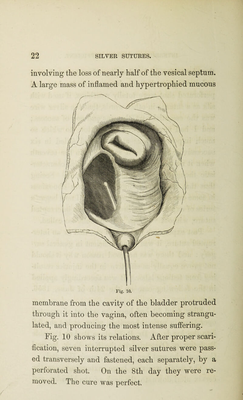 involving the loss of nearly half of the vesical septum. A large mass of inflamed and hypertrophied mucous membrane from the cavity of the bladder protruded through it into the vagina, often becoming strangu¬ lated, and producing the most intense suffering. Fig. 10 shows its relations. After proper scari¬ fication, seven interrupted silver sutures were pass¬ ed transversely and fastened, each separately, by a perforated shot. On the 8th day they were re¬ moved. The cure was perfect.