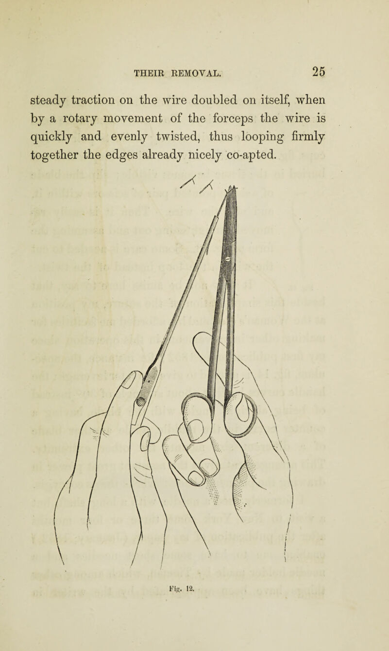 steady traction on the wire doubled on itself, when by a rotary movement of the forceps the wire is quickly and evenly twisted, thus looping firmly together the edges already nicely co-apted. Fig. 12.