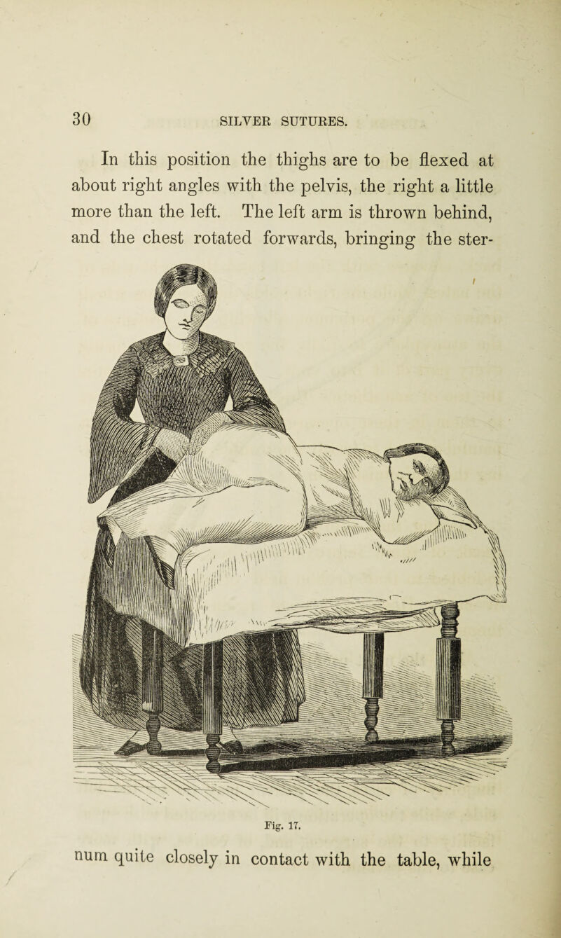 In this position the thighs are to be flexed at about right angles with the pelvis, the right a little more than the left. The left arm is thrown behind, and the chest rotated forwards, bringing the ster- Fig. 17. num quite closely in contact with the table, while